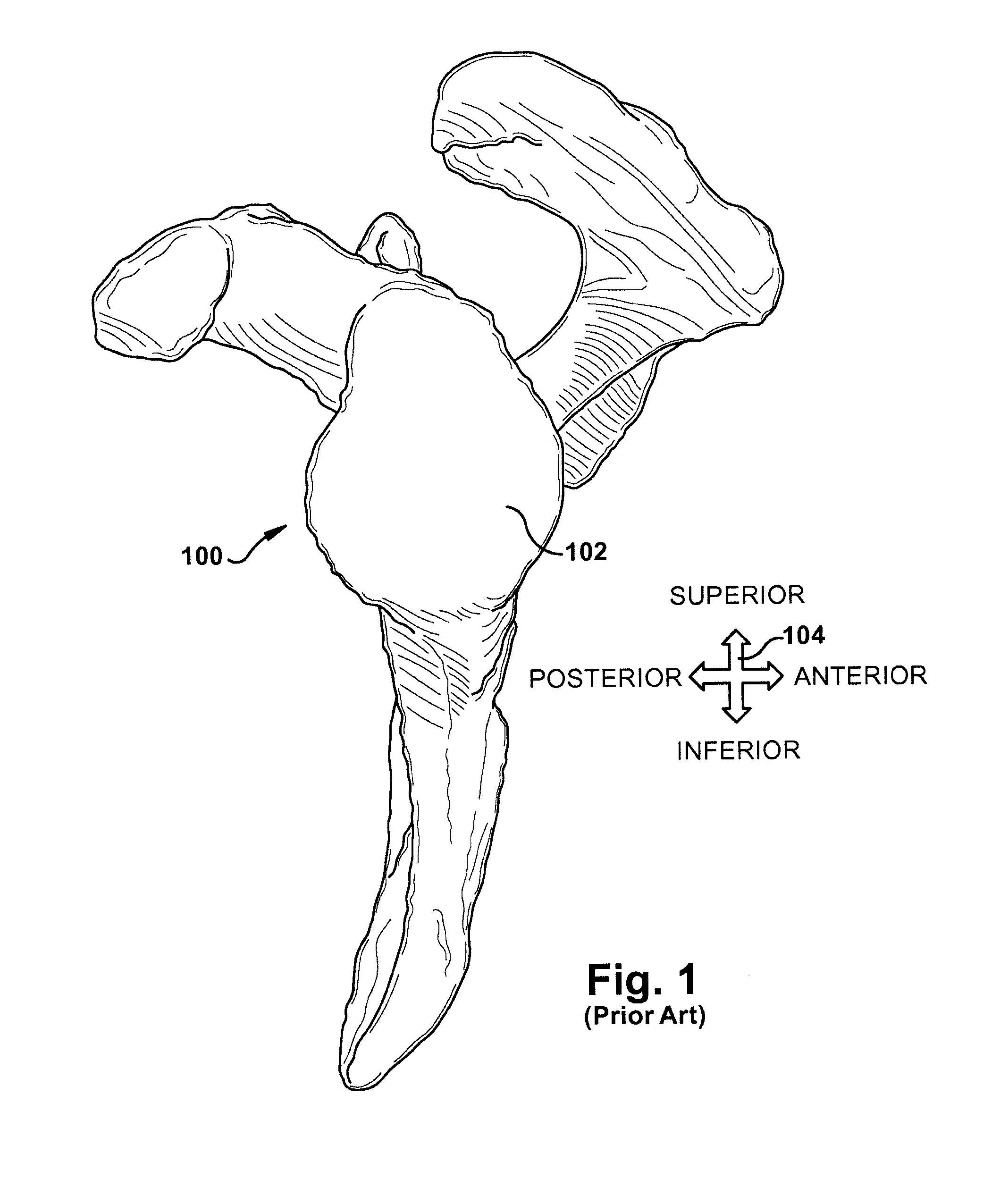 Guide for assisting with arrangement of a stock instrument with respect to a patient tissue