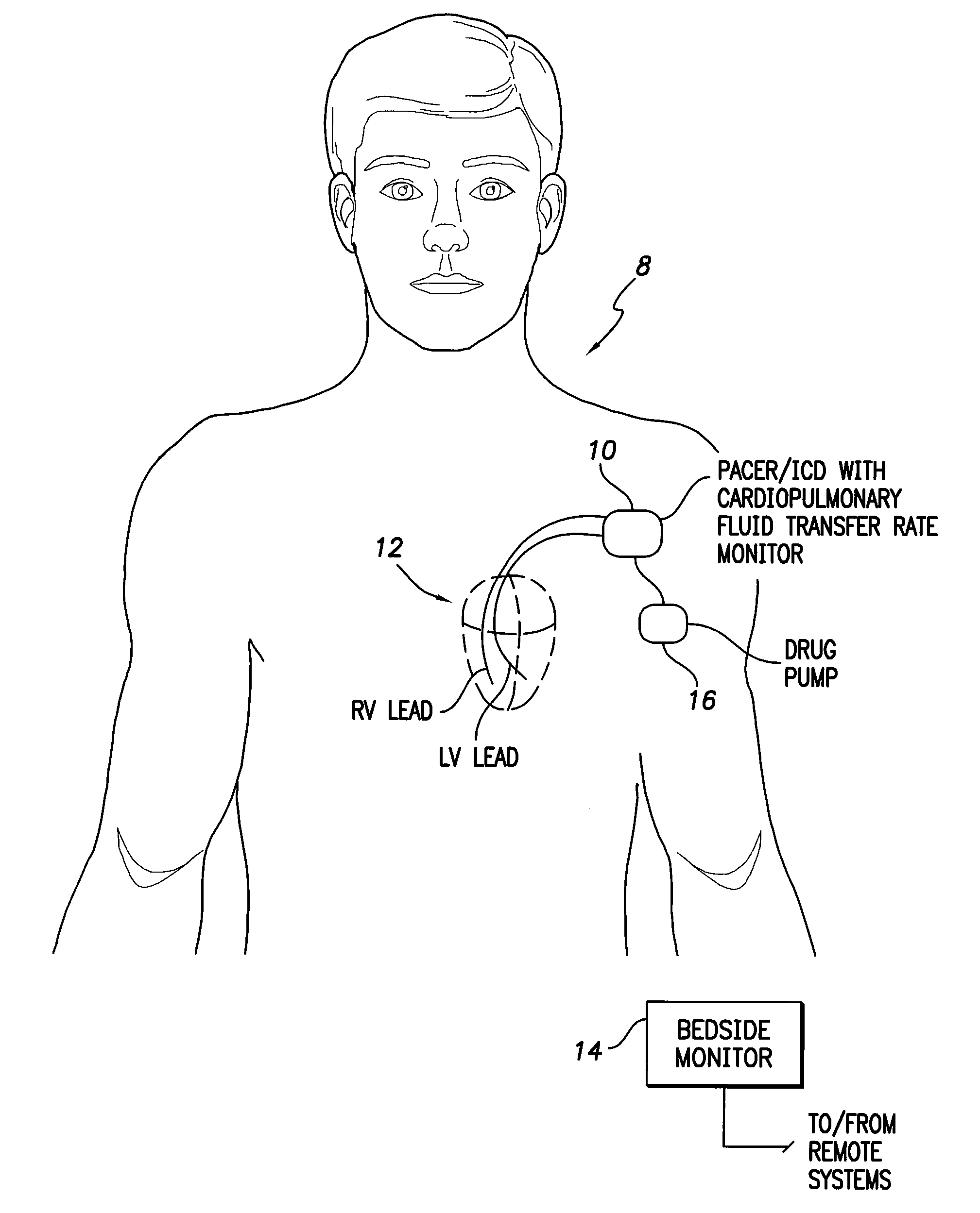 System and method for monitoring cardiopulmonary fluid transfer rates using an implantable medical device
