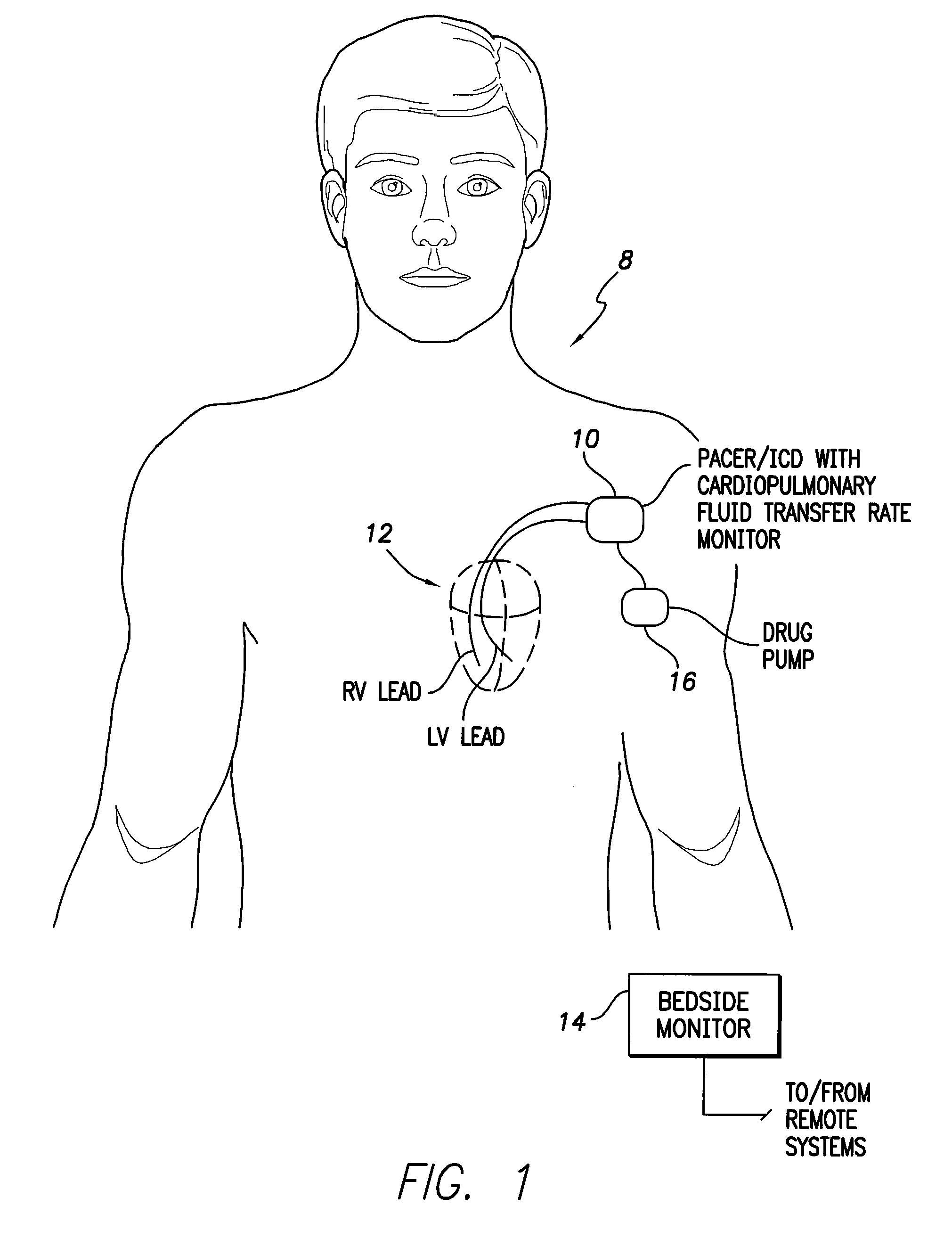 System and method for monitoring cardiopulmonary fluid transfer rates using an implantable medical device