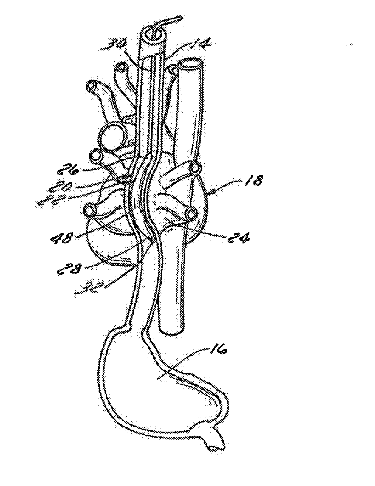 Method of Using an Intra-Esophageal Balloon System