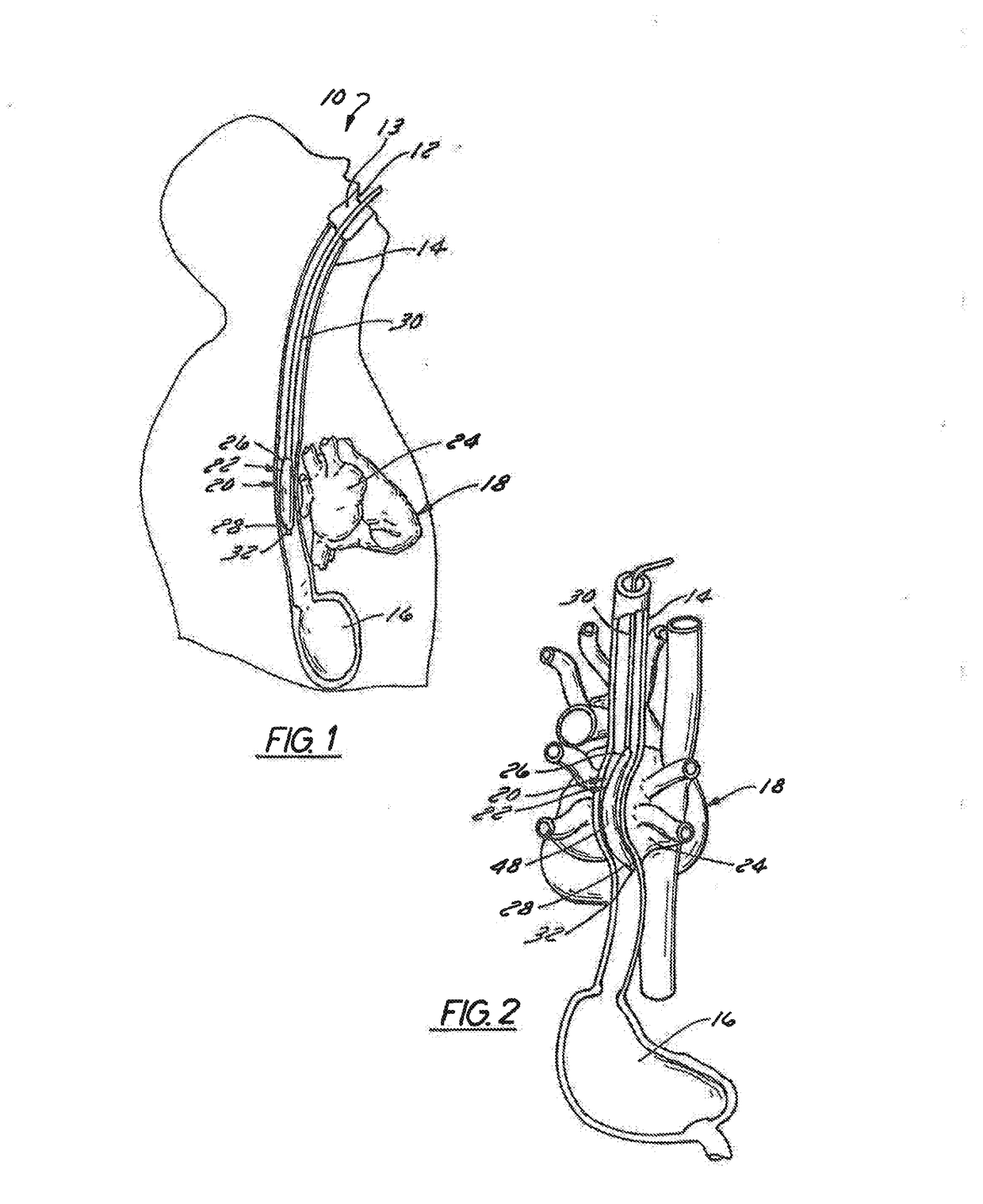 Method of Using an Intra-Esophageal Balloon System