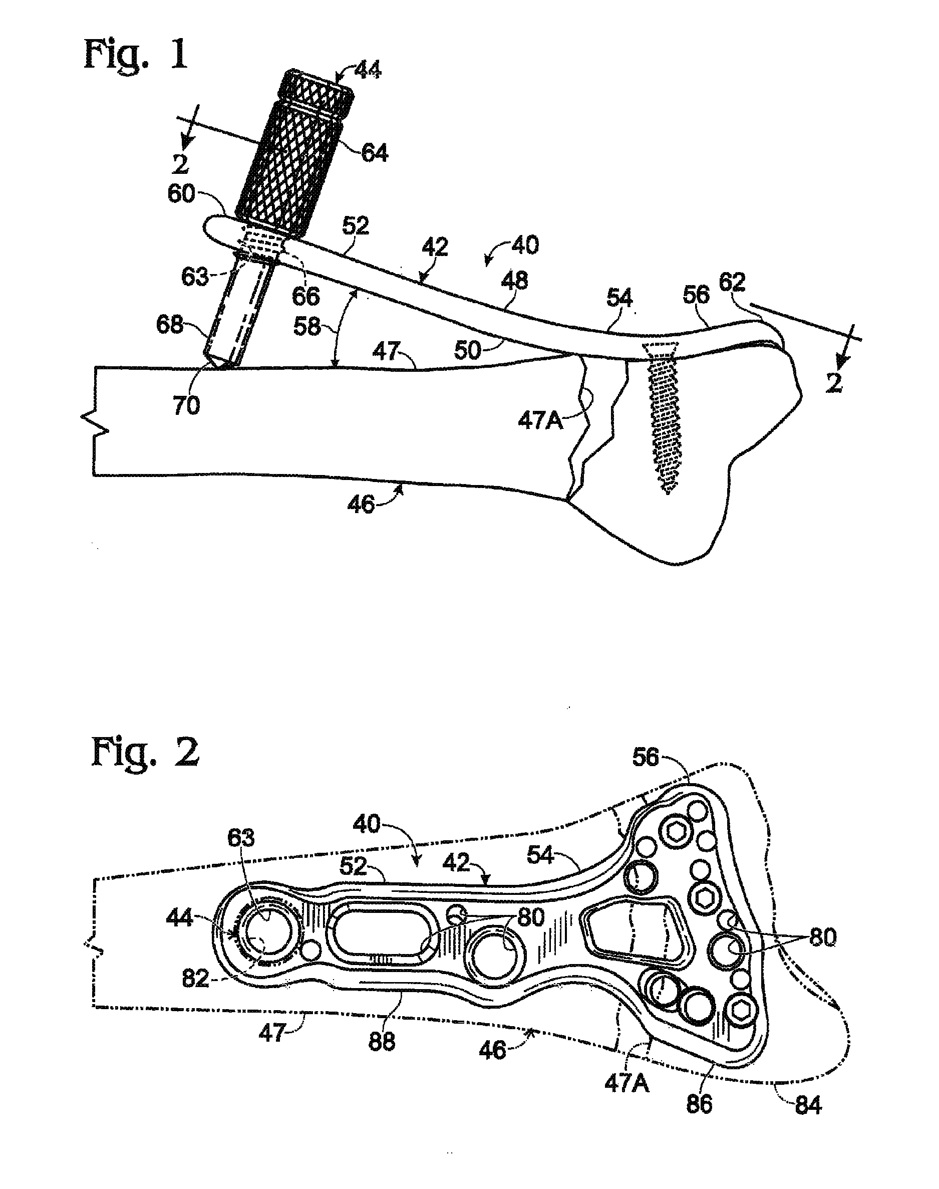 Bone plate supported by a leg member and used as a lever