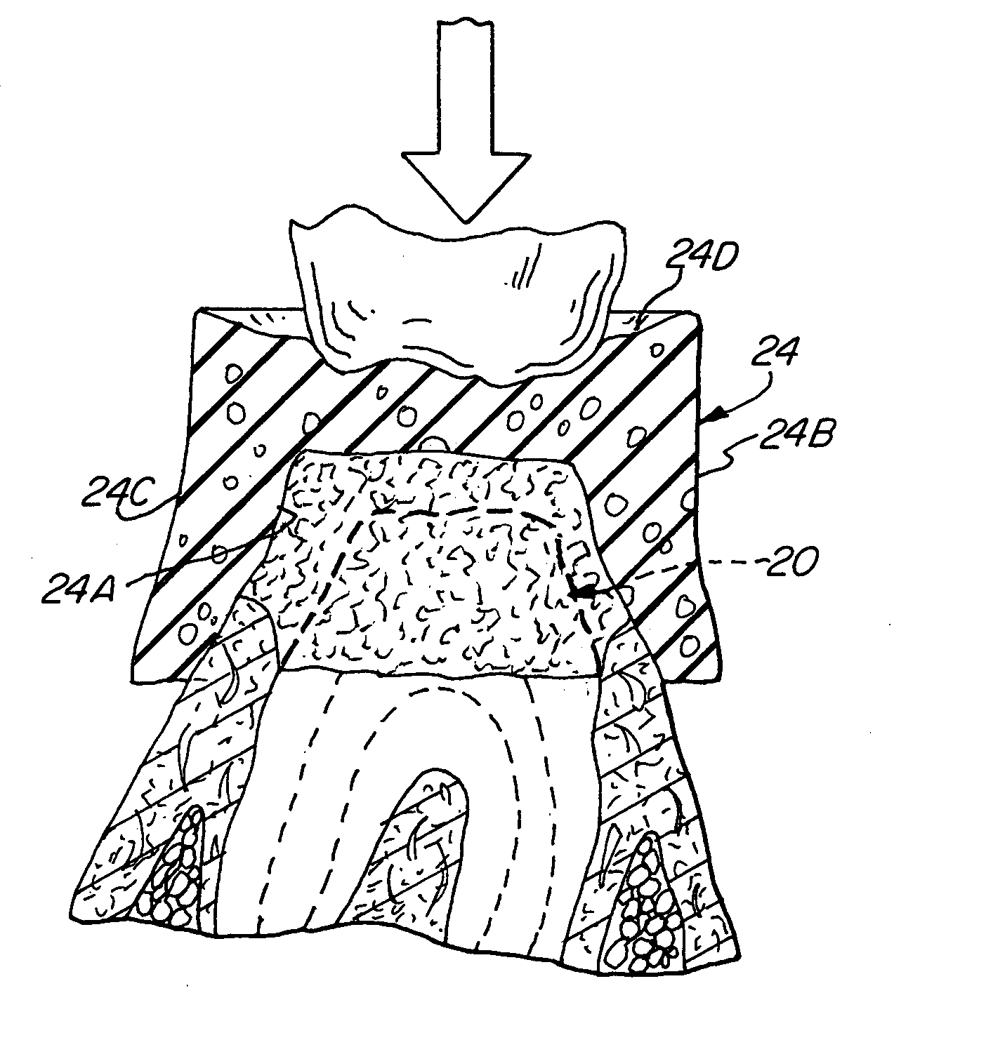 Method and device for the retraction and hemostasis of tissue during crown and bridge procedures