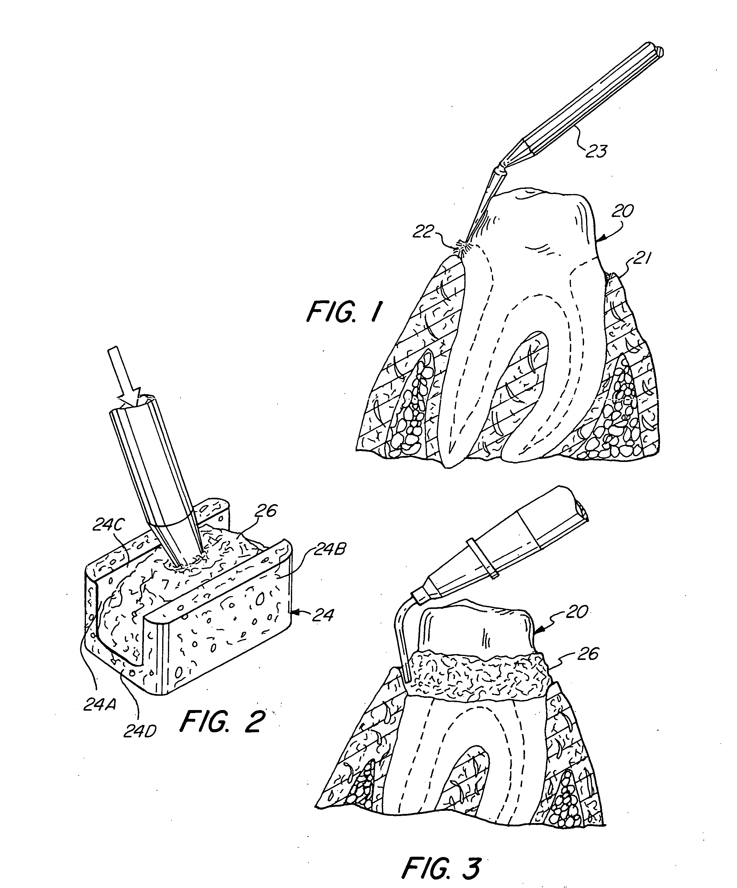 Method and device for the retraction and hemostasis of tissue during crown and bridge procedures