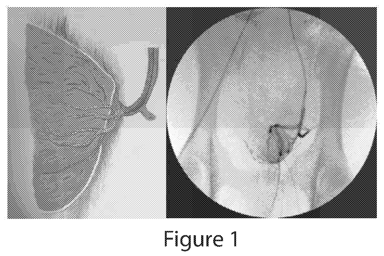 Flutamide Microsphere-Based Arterial Embolization for Treating Prostate Disorders