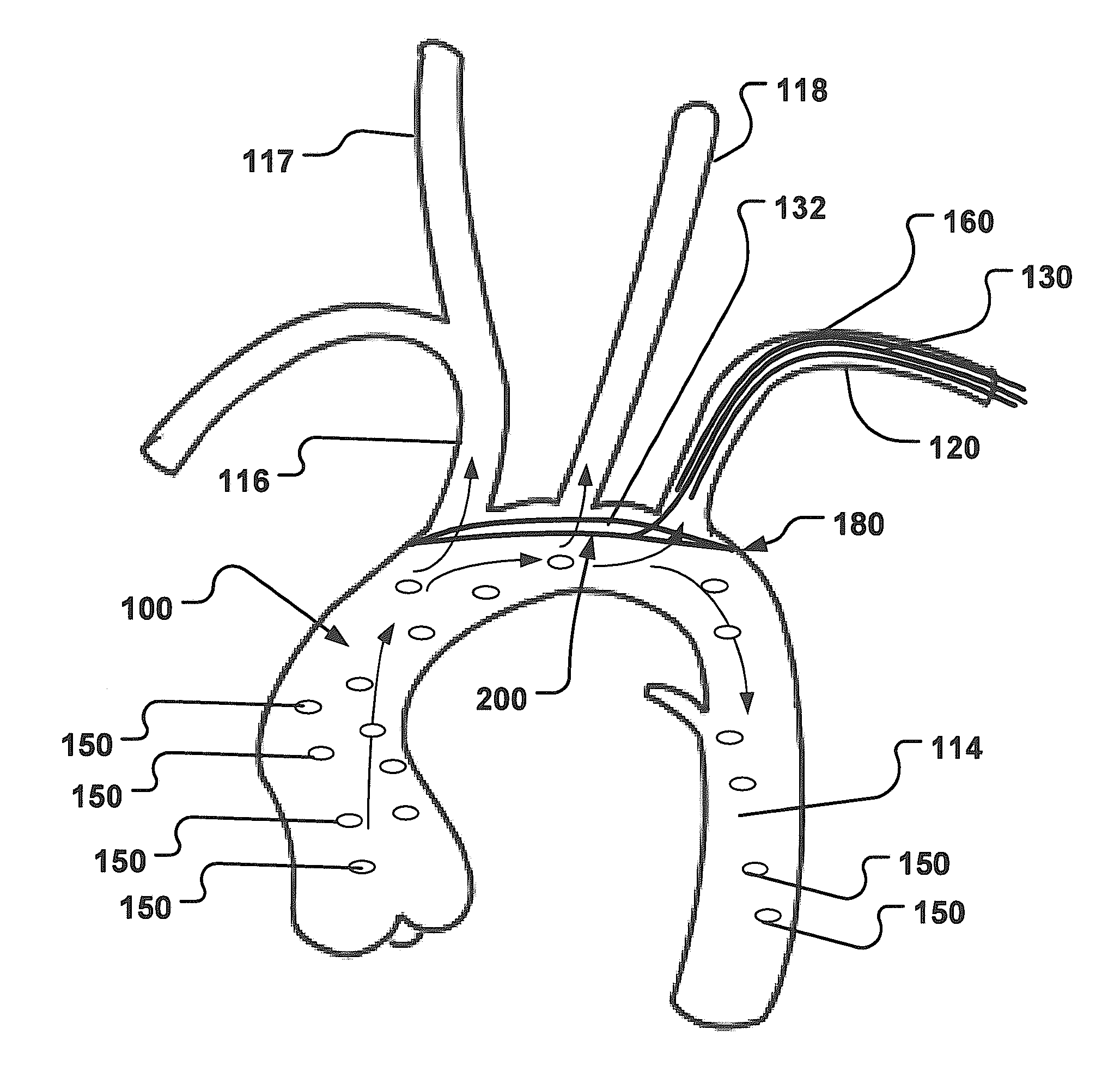 Temporary Embolic Protection Device And Medical Procedure For Delivery Thereof