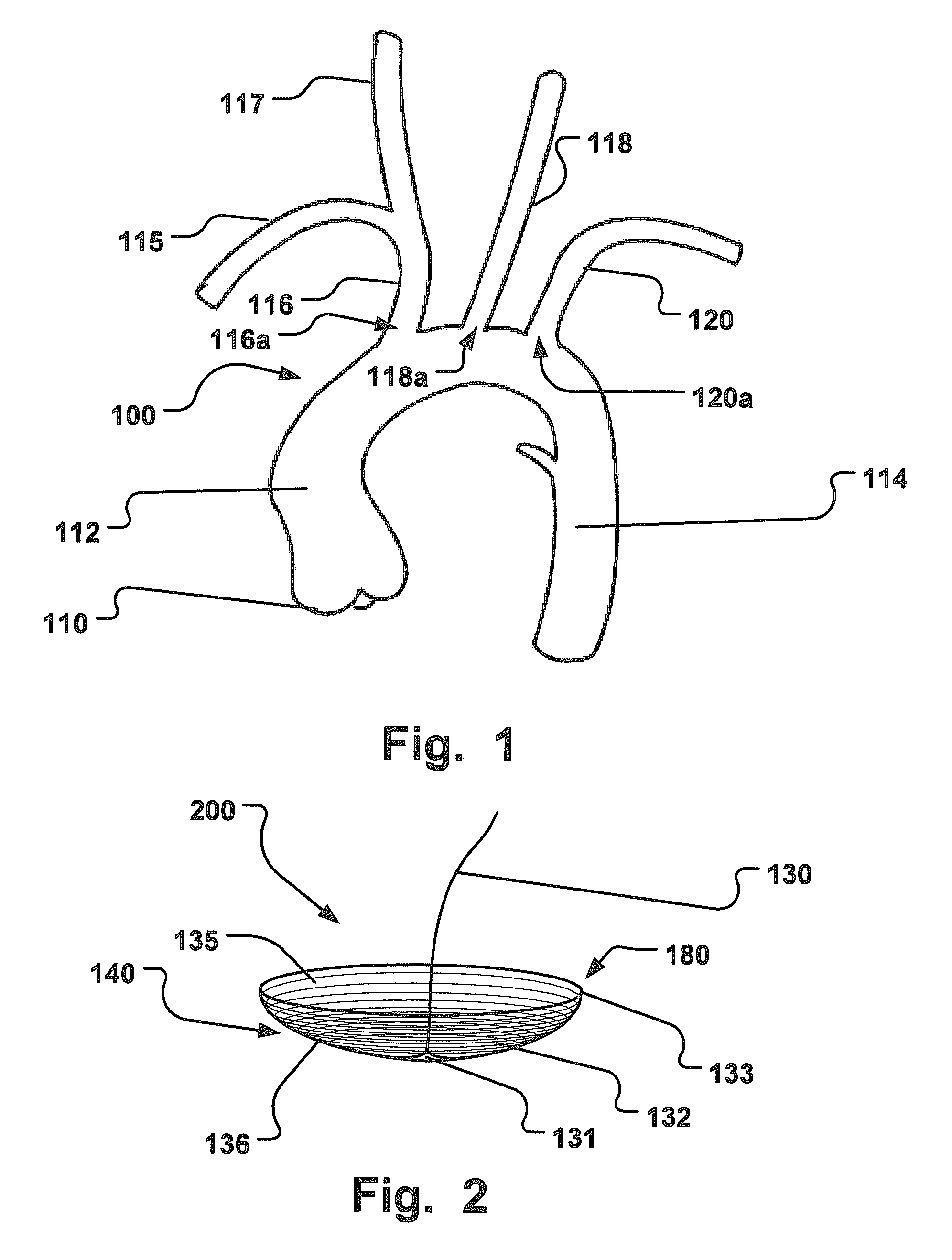 Temporary Embolic Protection Device And Medical Procedure For Delivery Thereof