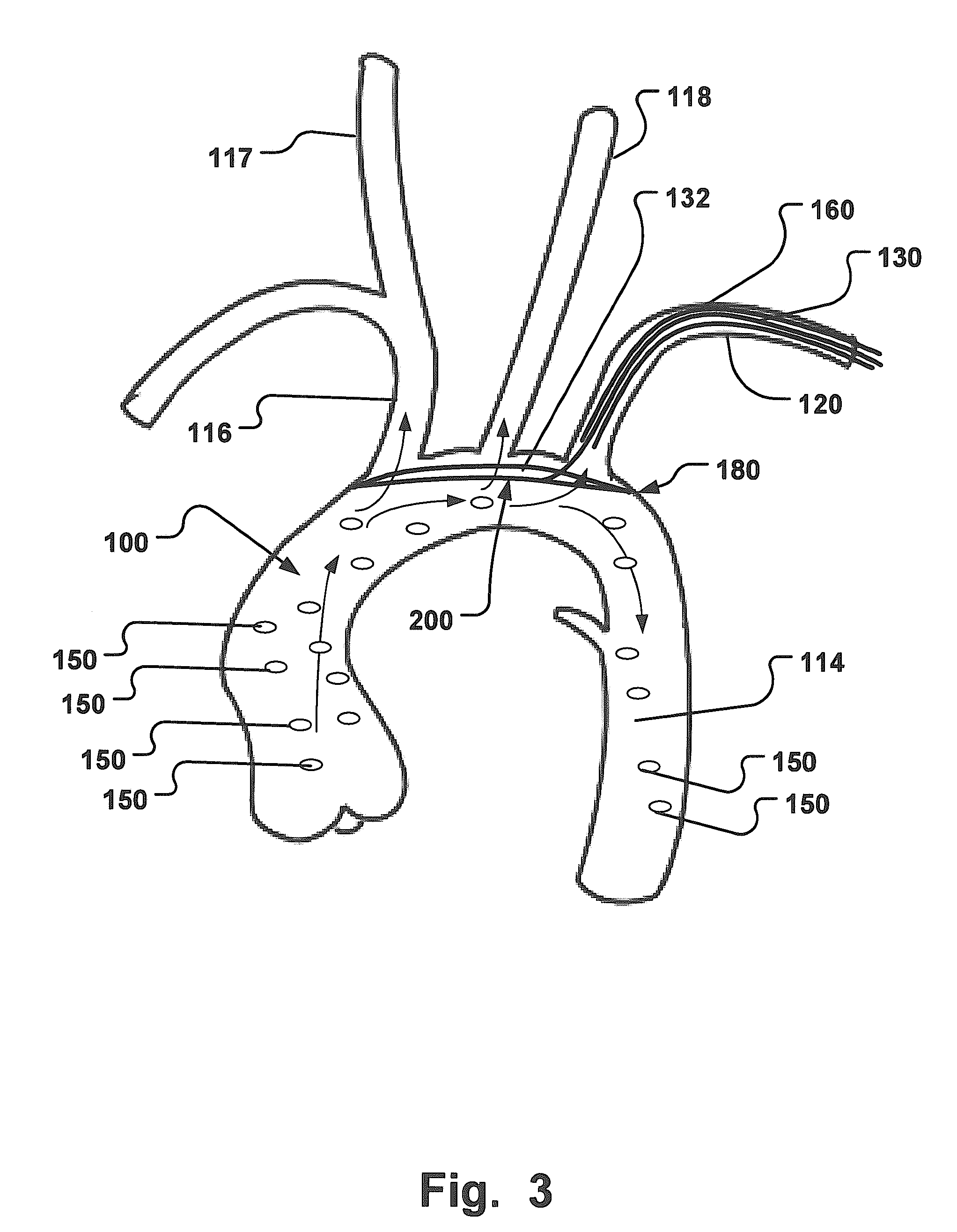 Temporary Embolic Protection Device And Medical Procedure For Delivery Thereof