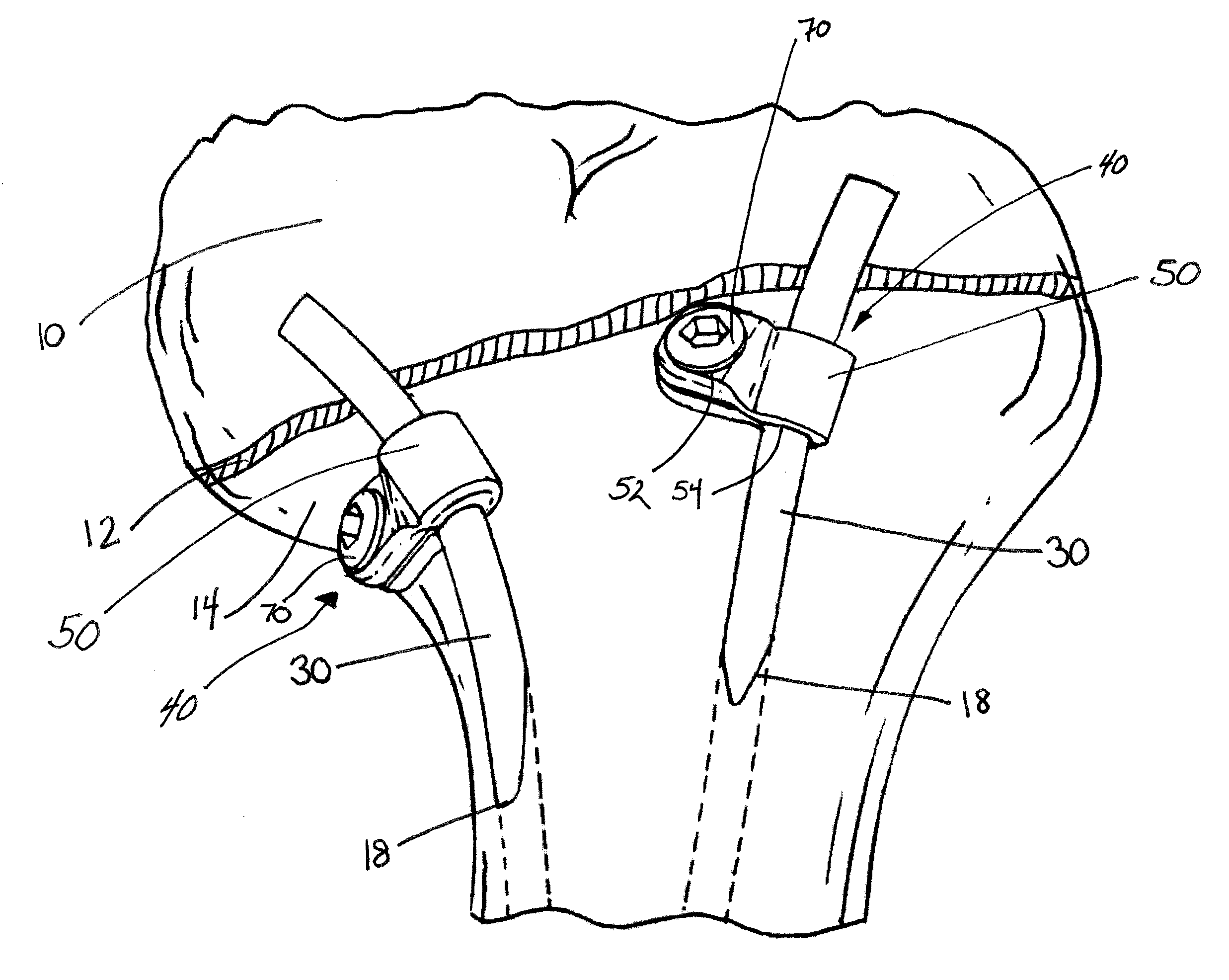 Clamp For A Medical Implant And A Method For Using The Same