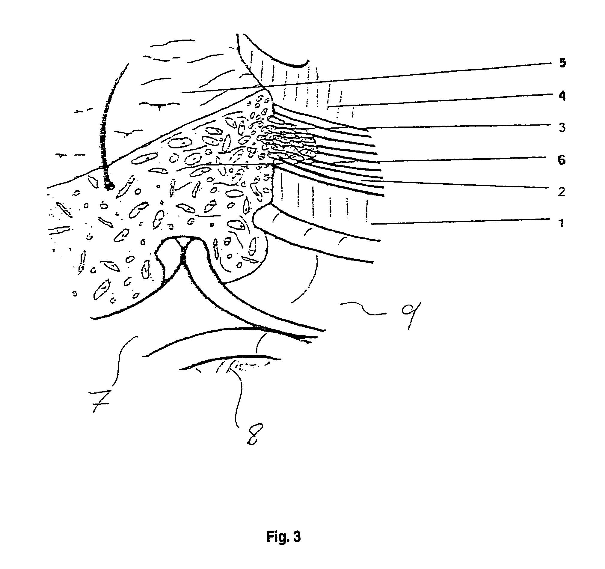 Implant with surface structure