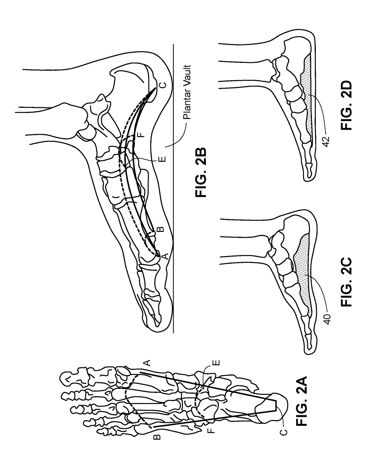Methods and systems for sizing an orthotic device