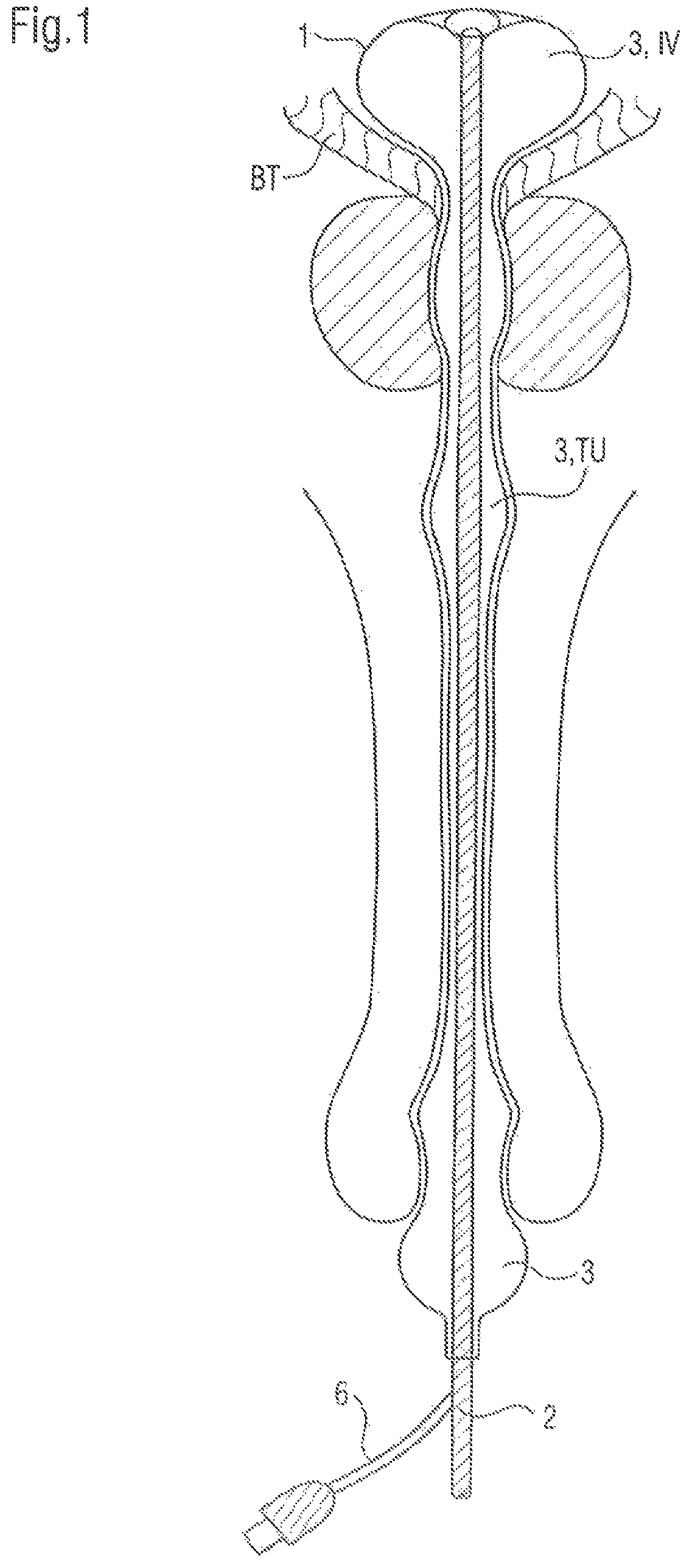 Bladder catheter for the minimally invasive discharge of urine