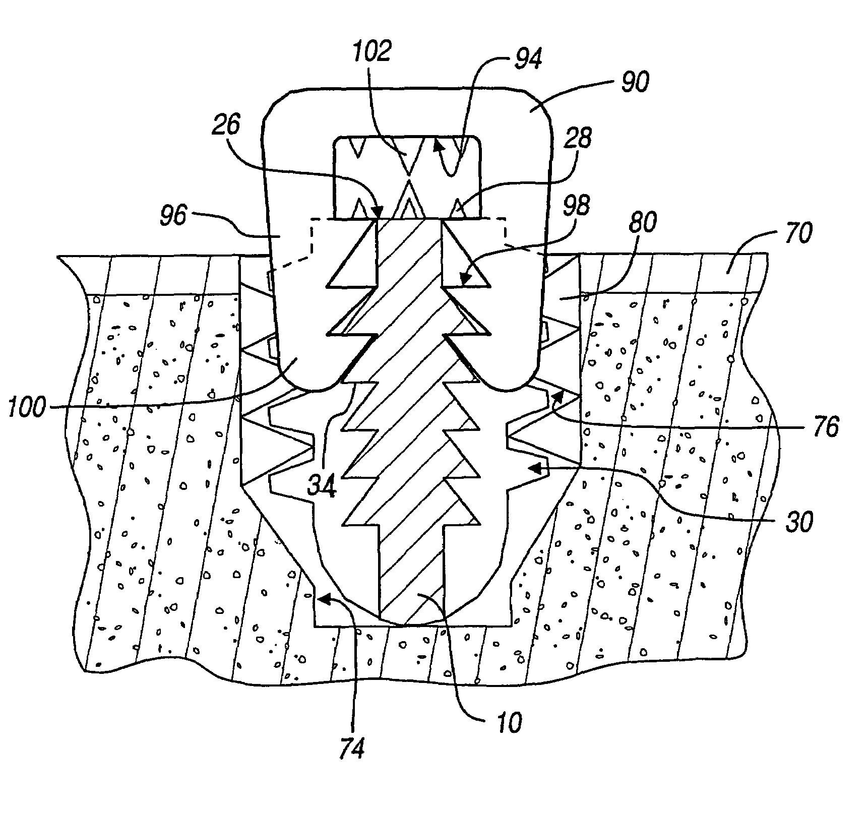 Method and apparatus for use of a self-tapping resorbable screw