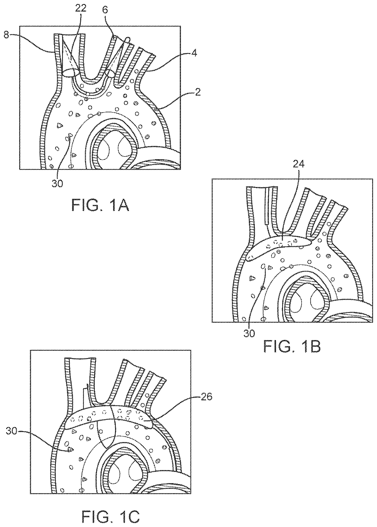 Accessory device to provide neuroprotection during interventional procedures
