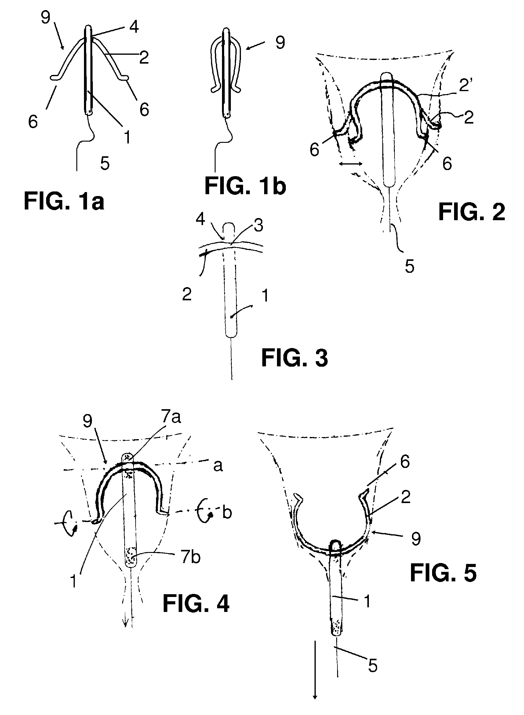 Plastic frame for an intrauterine device