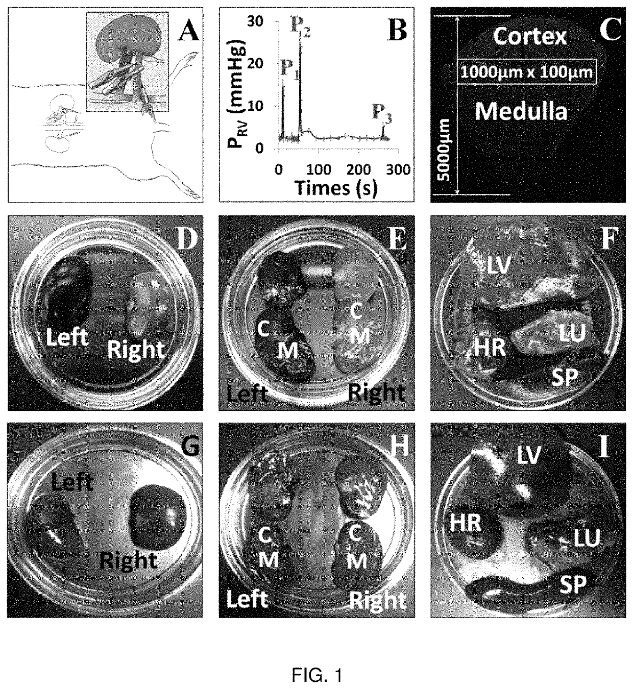 Hydrodynamic method and apparatus for delivering fluids to kidney tissues