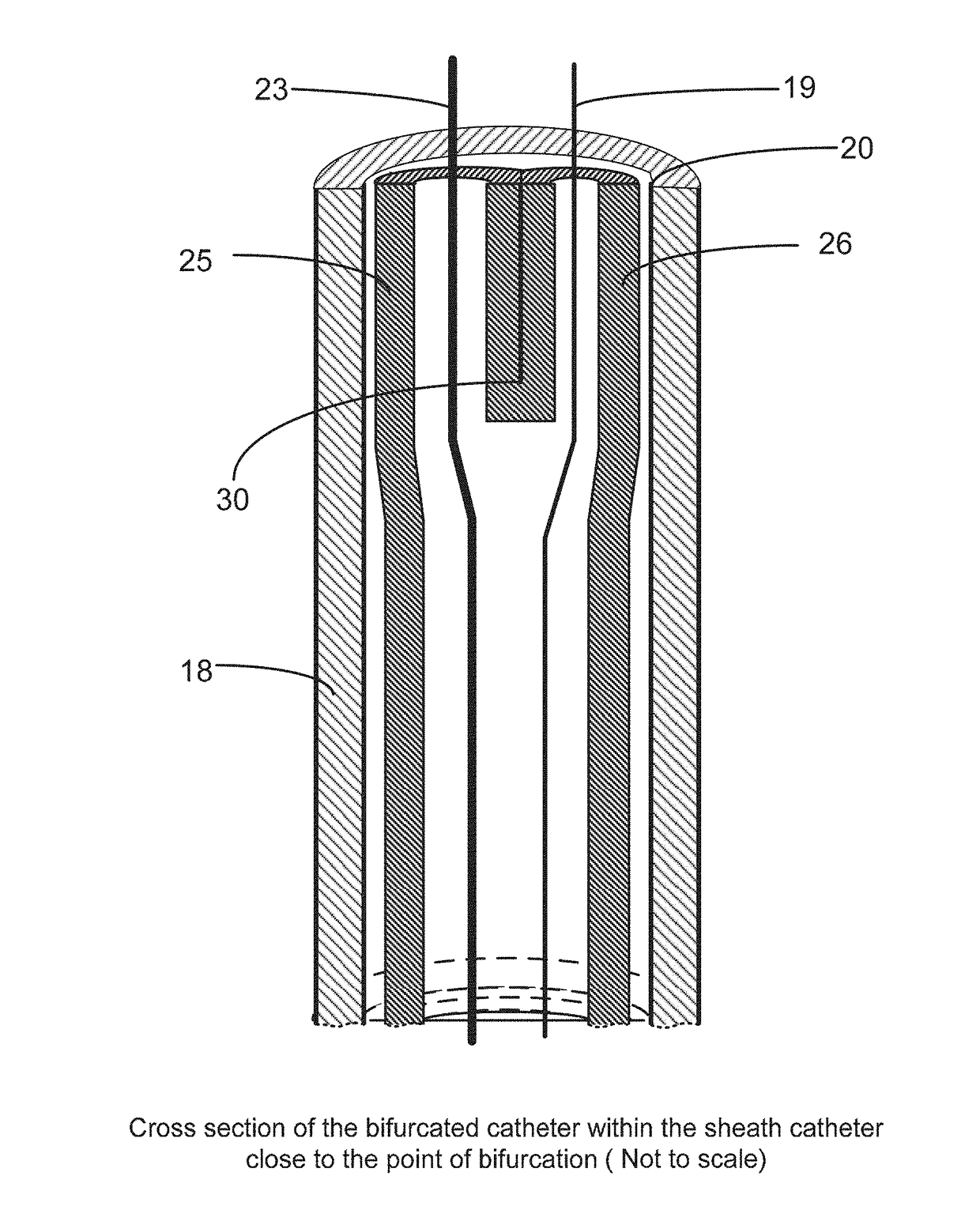 Apparatus and method for stabilization of procedural catheter in tortuous vessels