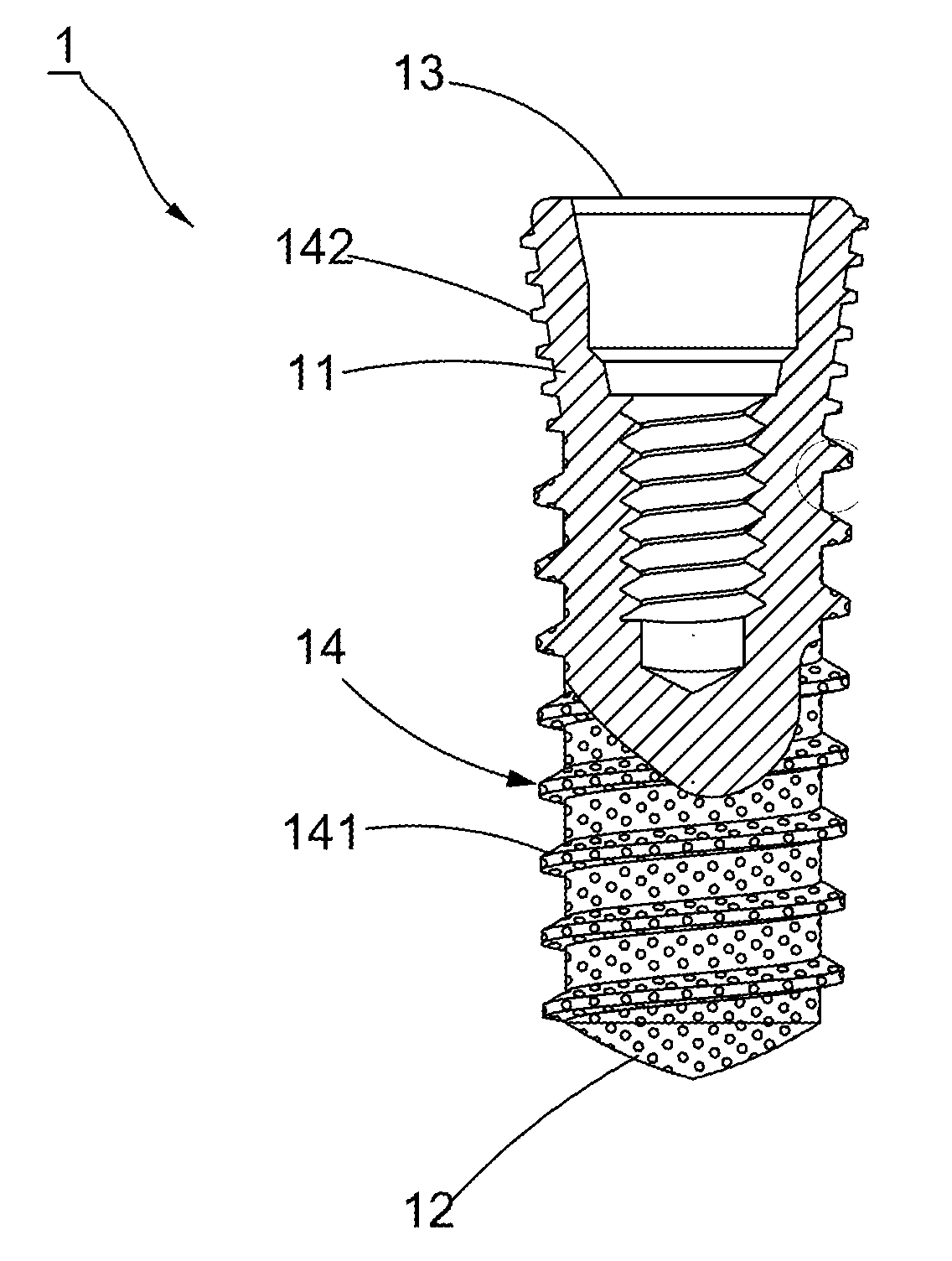 Root implant