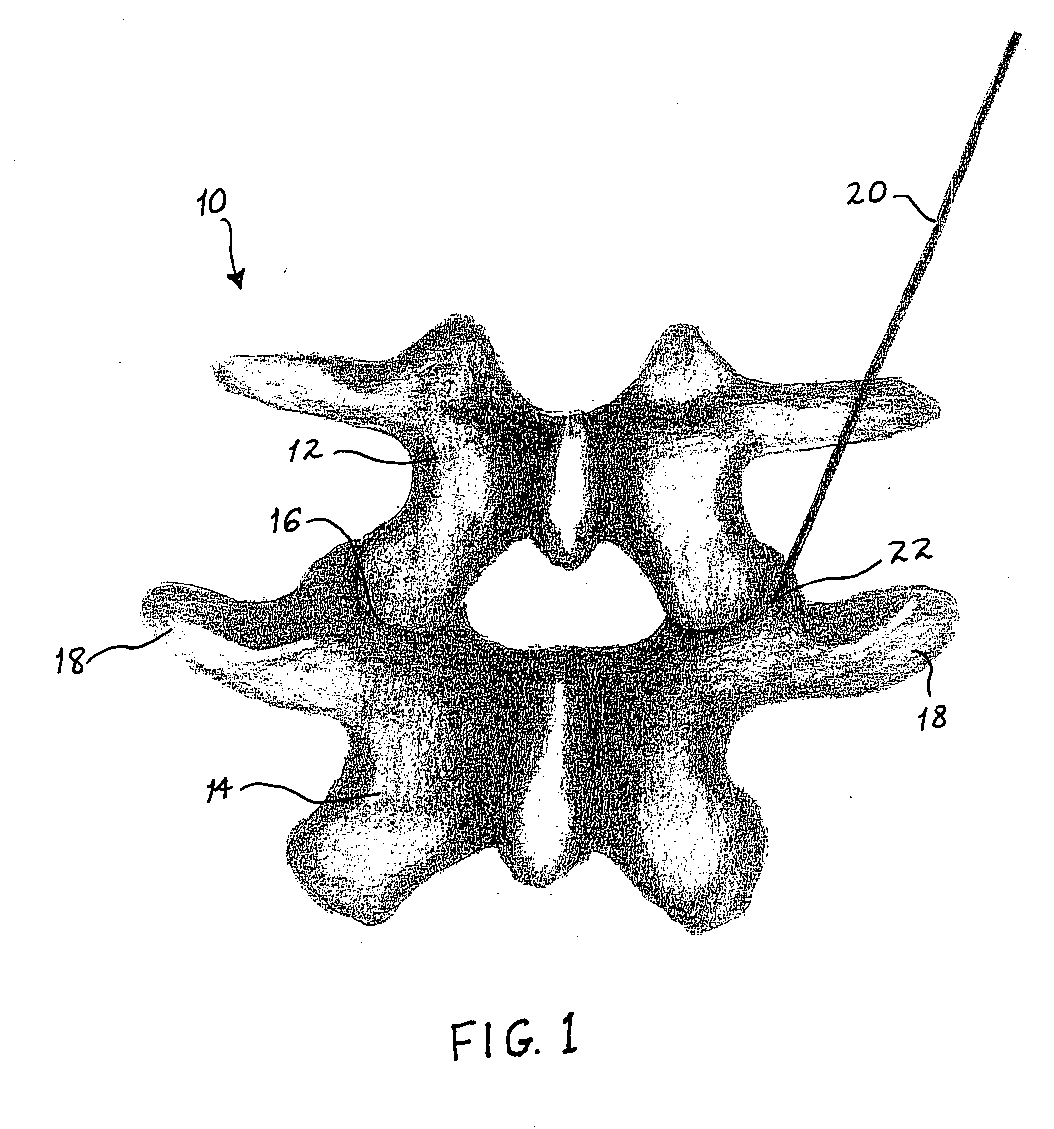 Minimally-invasive method for performing spinal fusion and bone graft capsule for facilitating the same