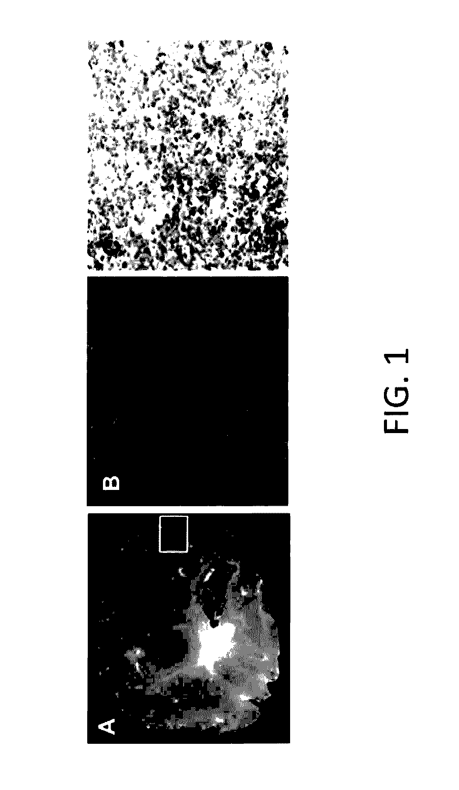 Inhibition of leukotriene synthesis and activity in the treatment of sonic hedgehog-associated medulloblastoma