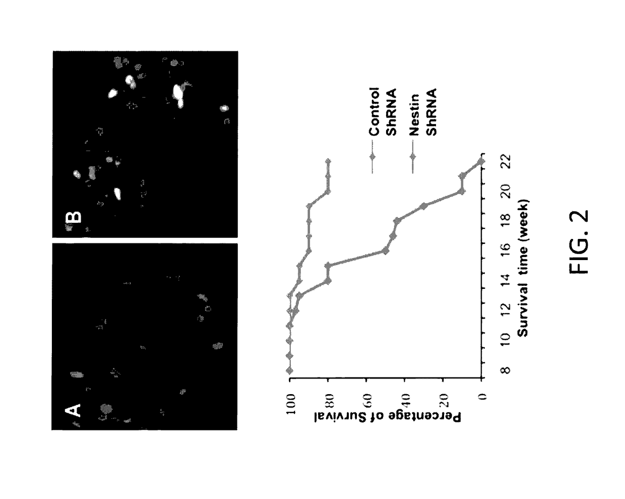 Inhibition of leukotriene synthesis and activity in the treatment of sonic hedgehog-associated medulloblastoma