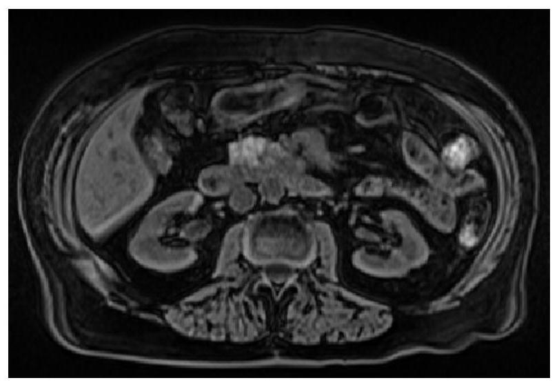 Low-field-intensity MR stomach segmentation method based on transfer learning image enhancement