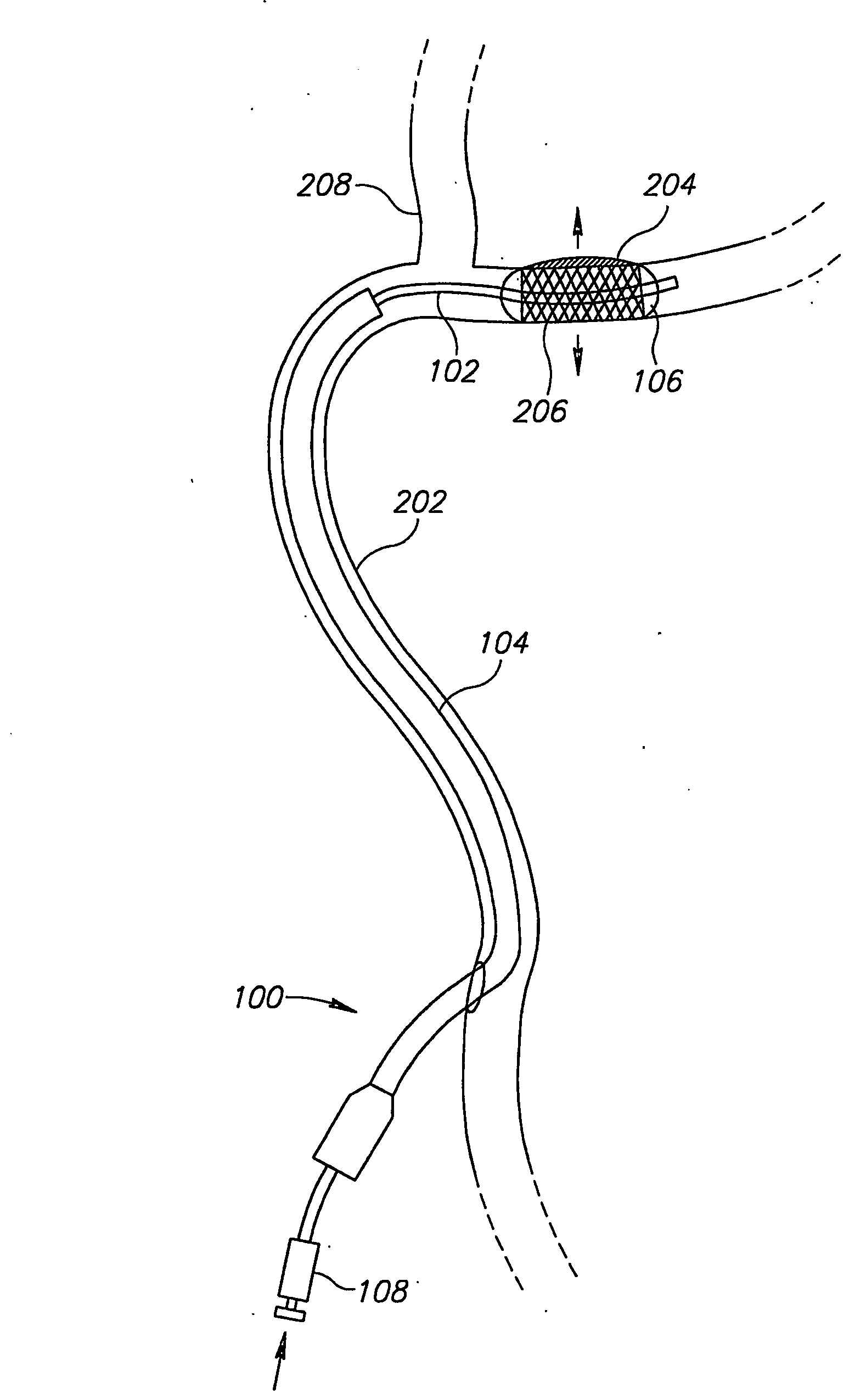 Stent Positioning Using Inflation Tube
