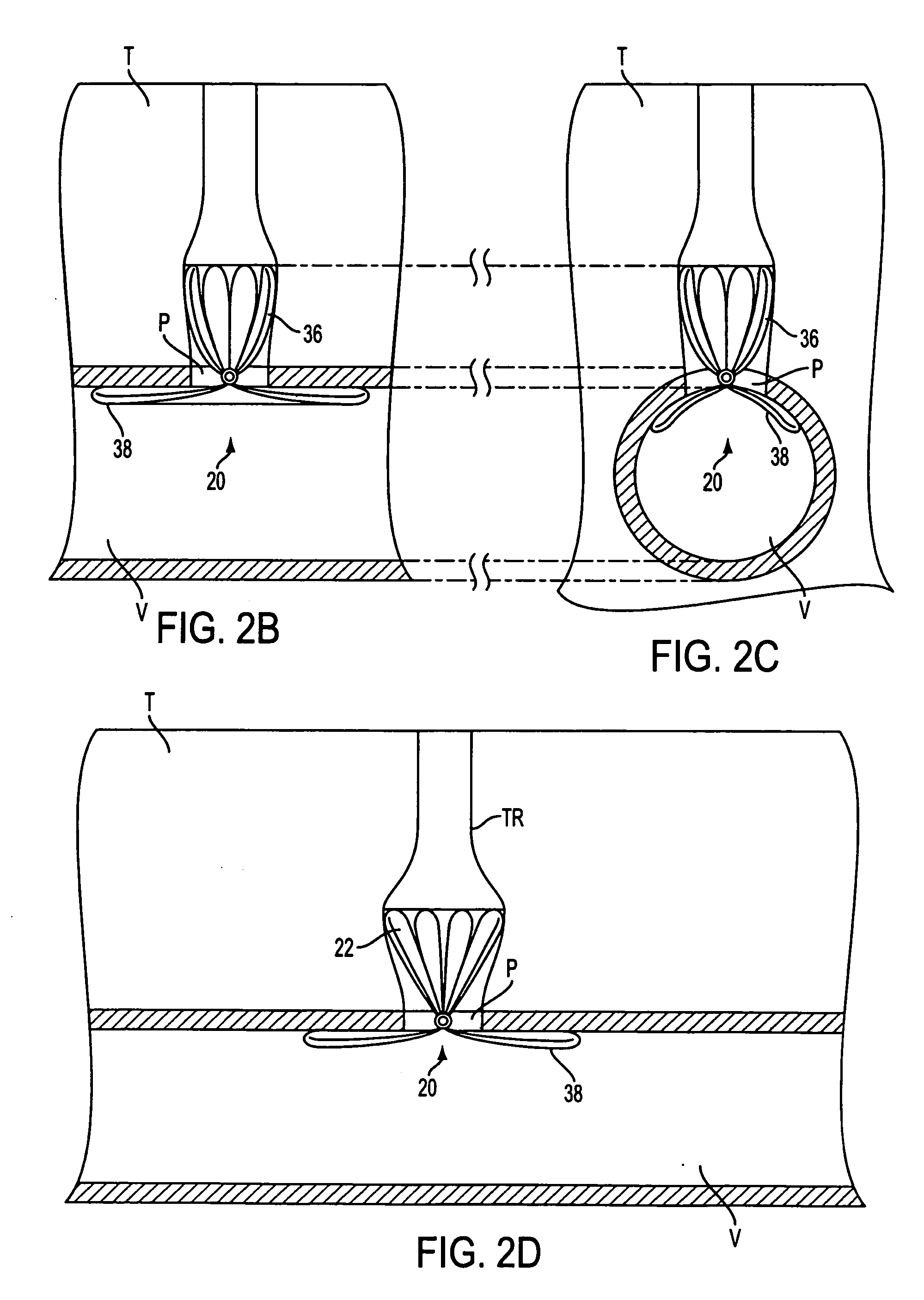 Apparatus for sealing surgical punctures