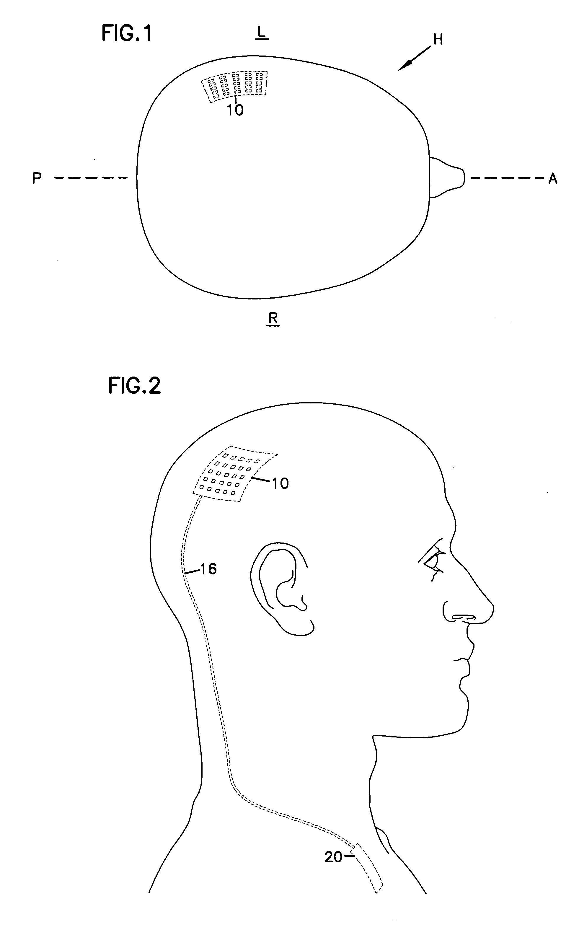 Neural blocking therapy