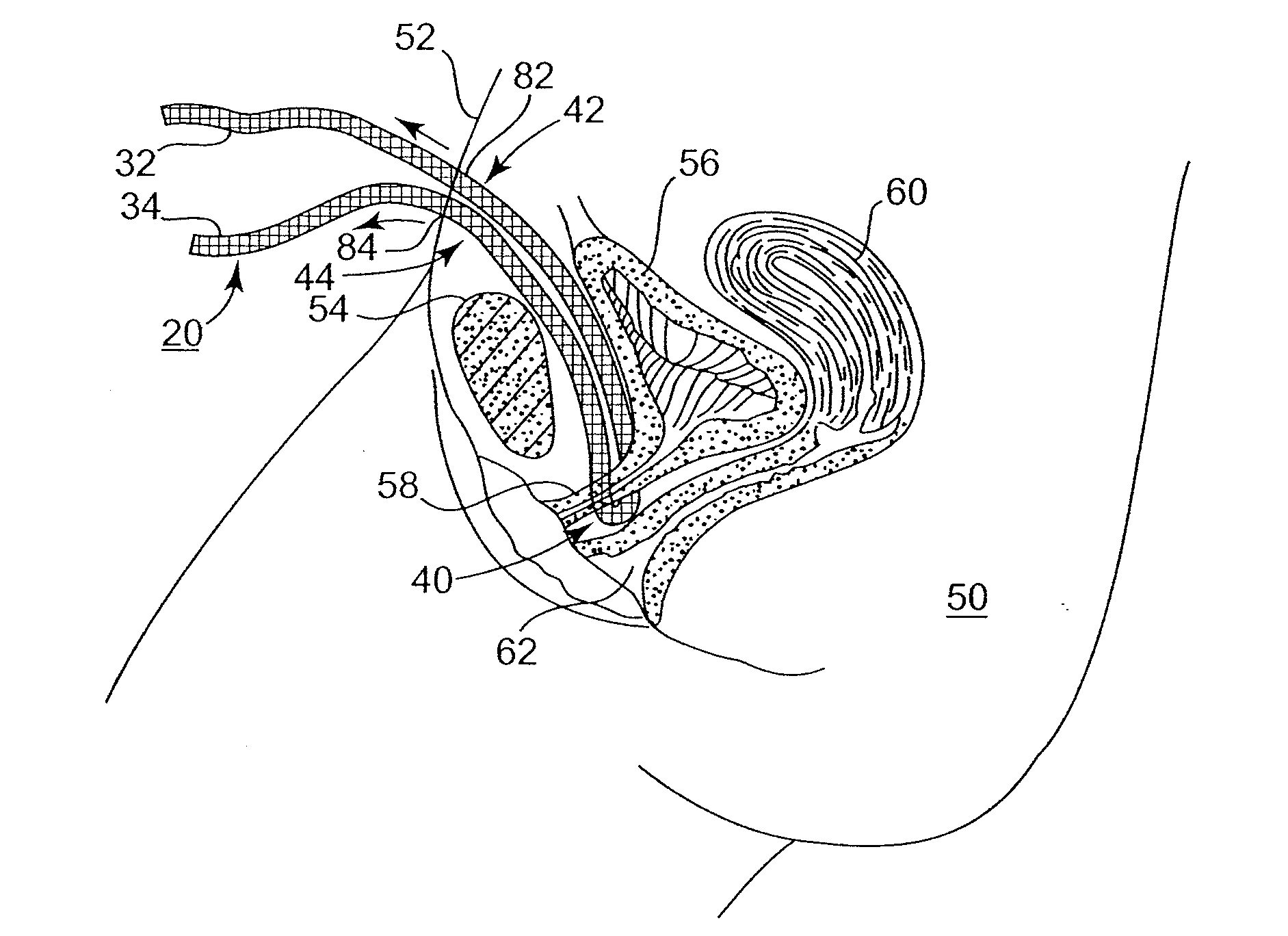Adjustable Sling and Method of Treating Pelvic Conditions