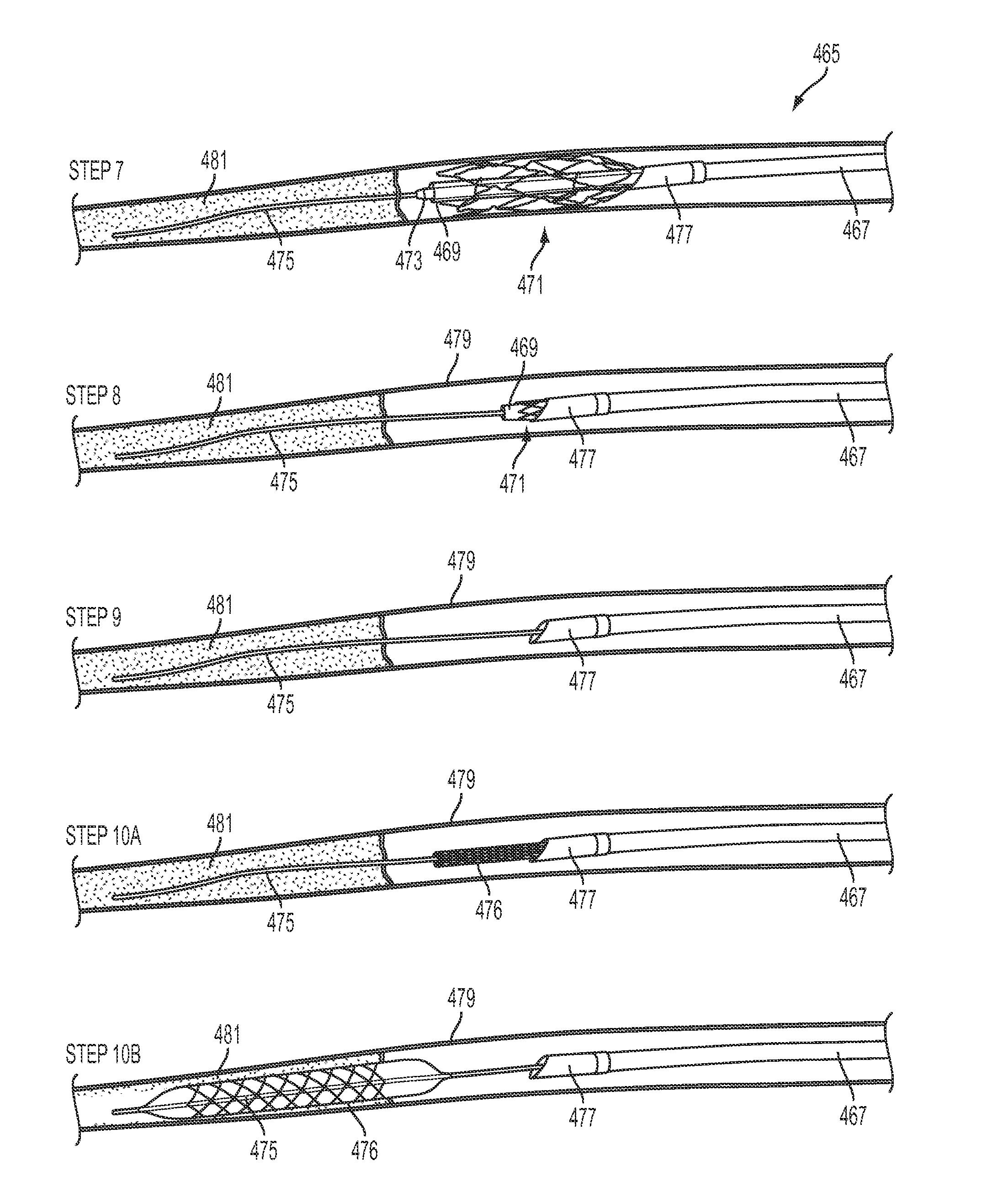 Method and apparatus for placing a catheter within a vasculature