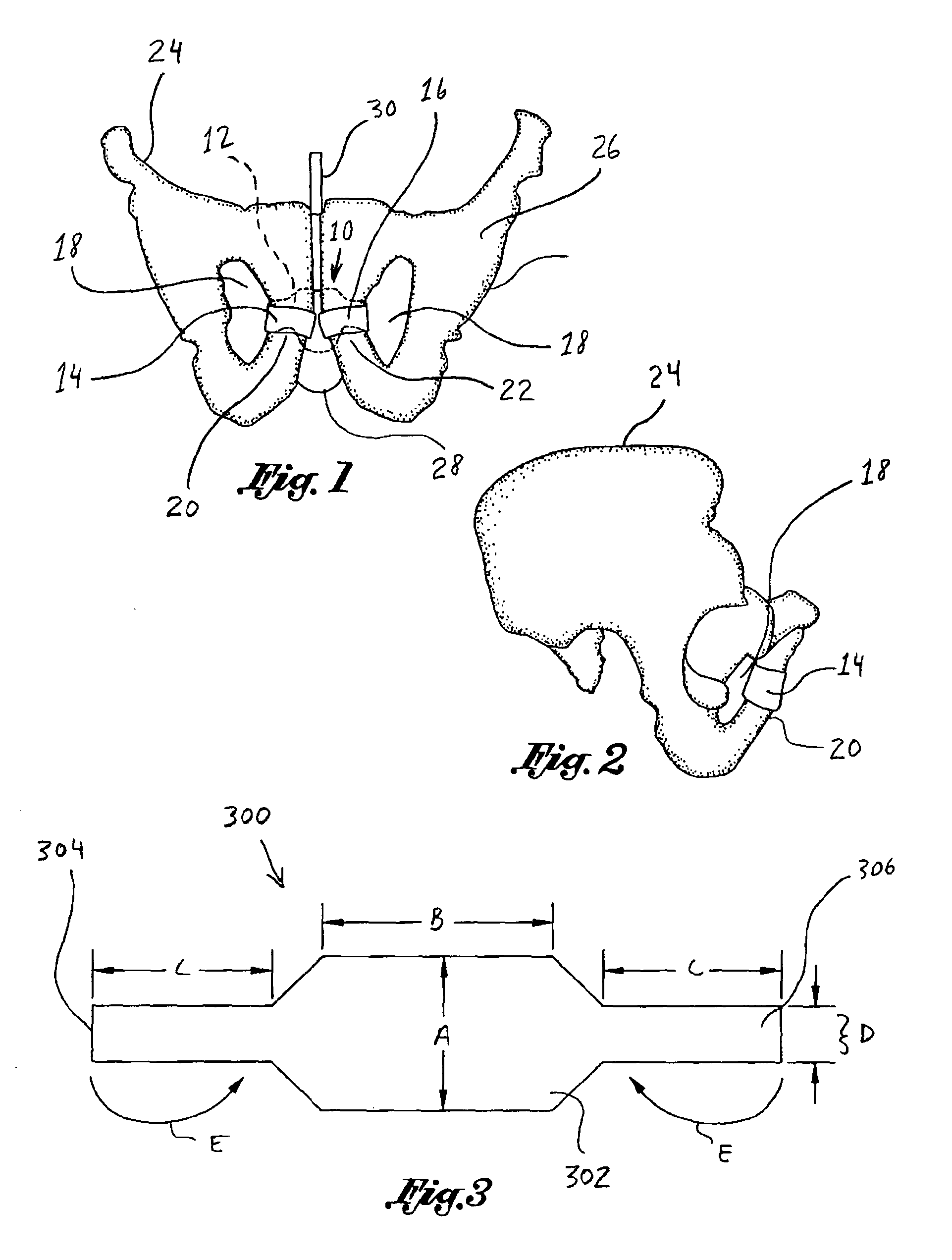 Implantable Sling For The Treatment Of Male Incontinence And Method Of Using The Same
