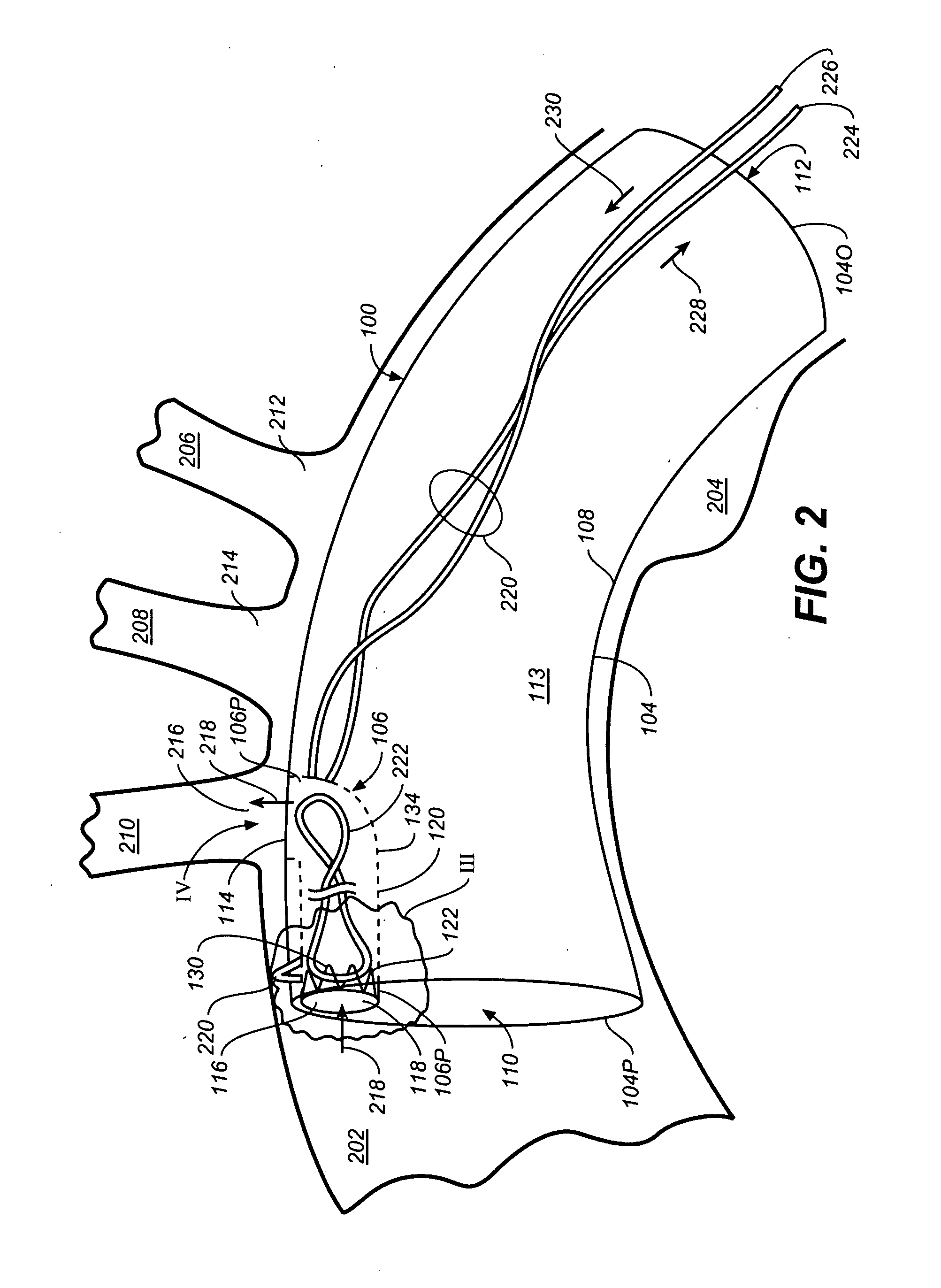 Eversible Branch Stent-Graft and Deployment Method