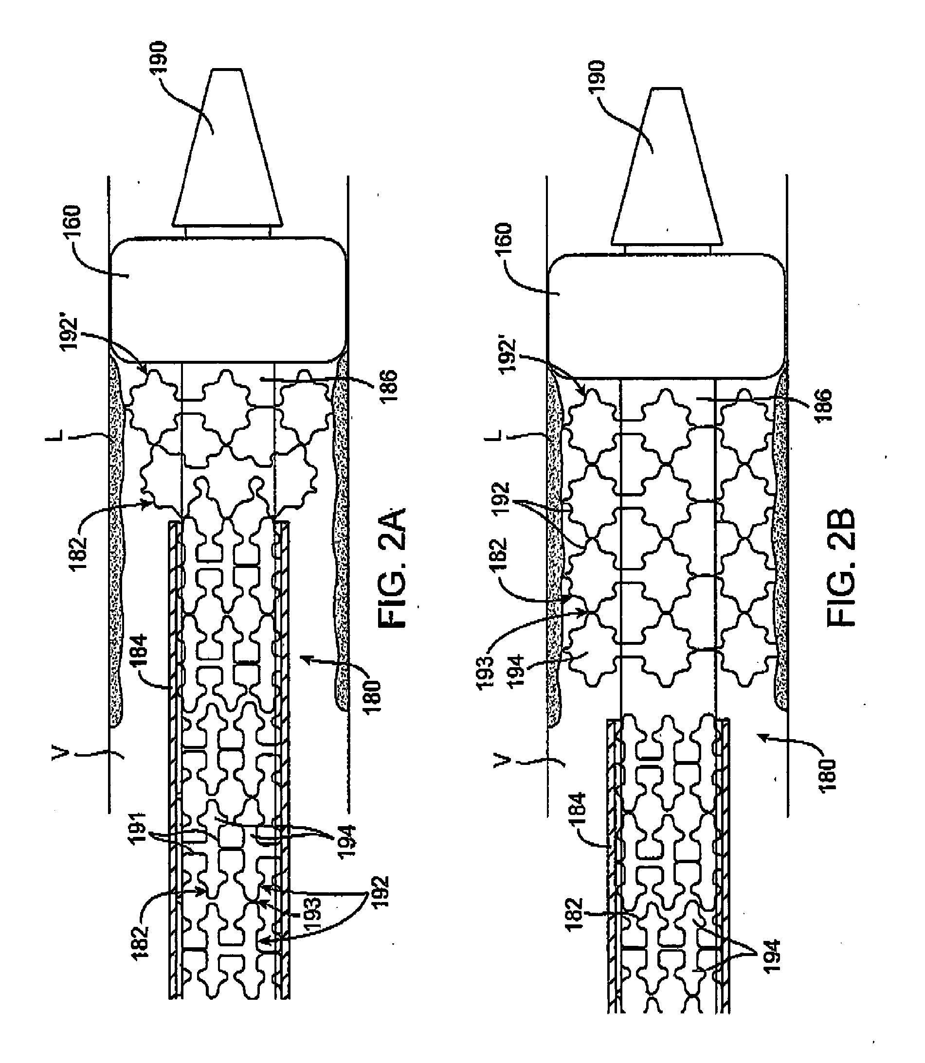 Custom-length self-expanding stent delivery systems with stent bumpers