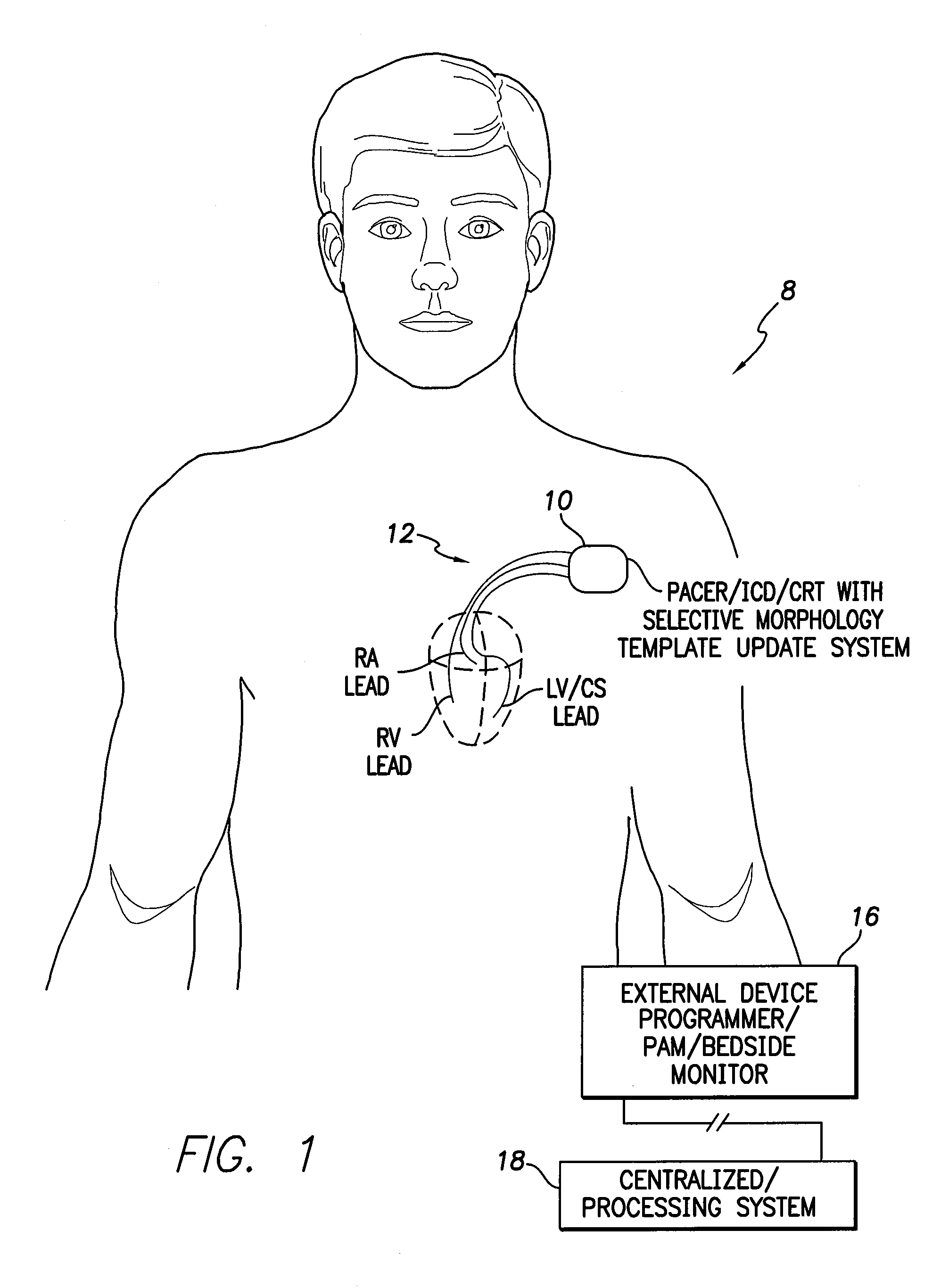 Systems and methods for selectively updating cardiac morphology discrimination templates for use with implantable medical devices