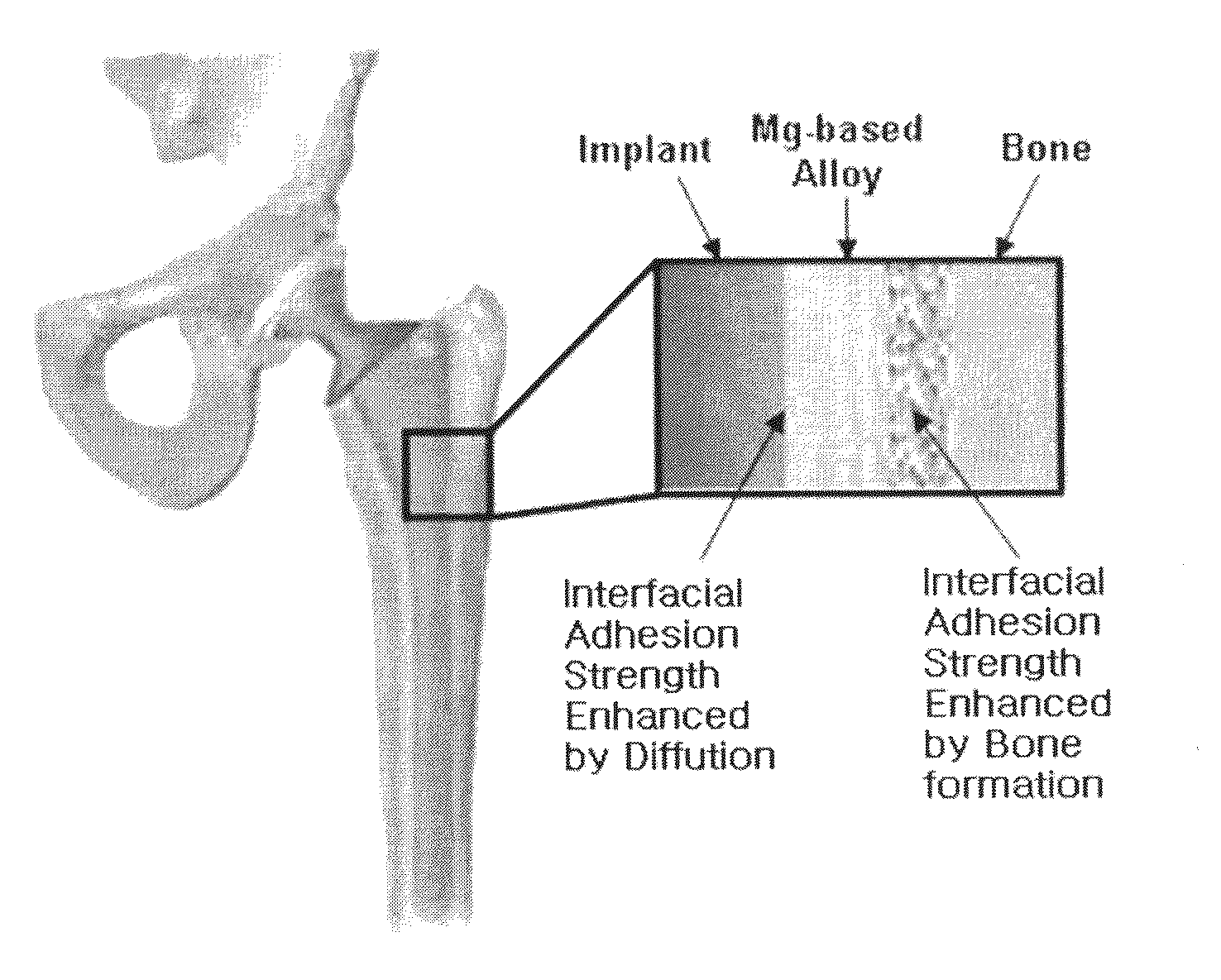 Implants comprising biodegradable metals and method for manufacturing the same