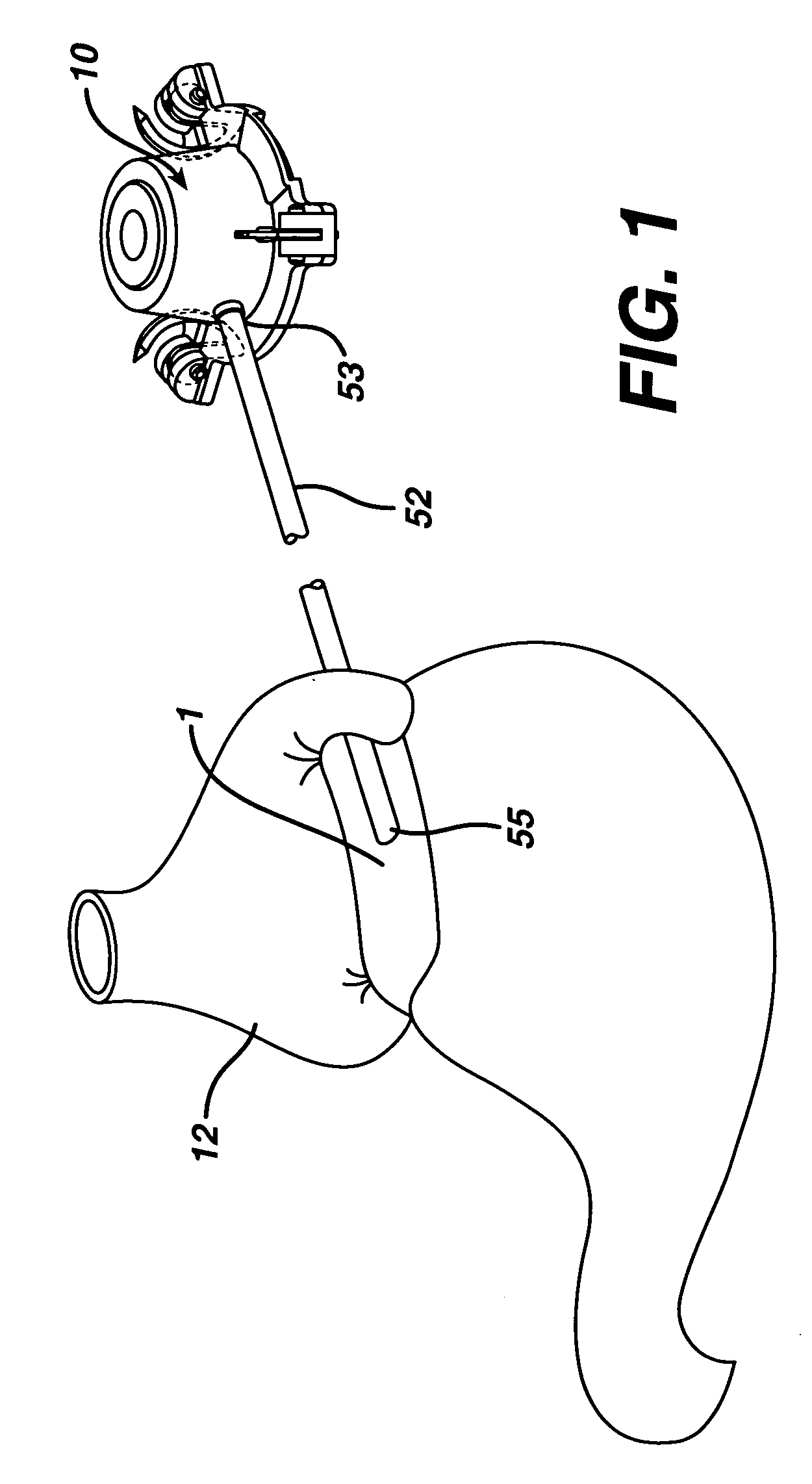 Method of implanting a fluid injection port