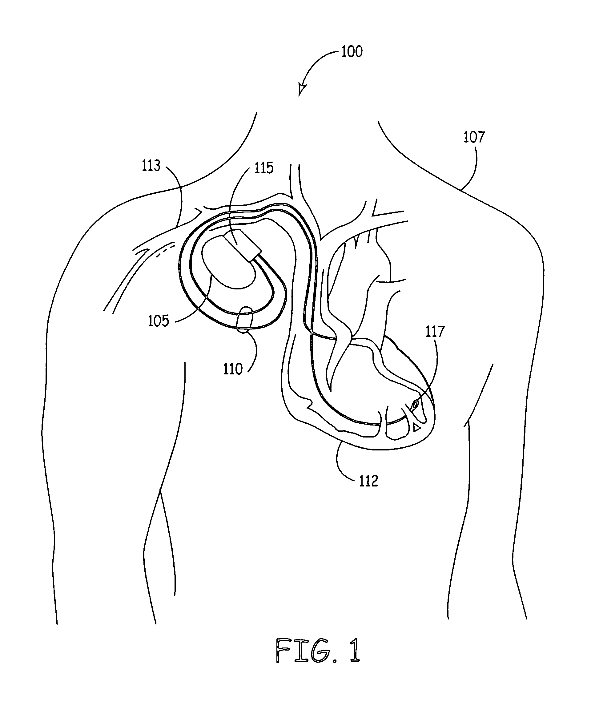 Methods and apparatus for reducing spurious signals in implantable medical devices caused by x-ray radiation