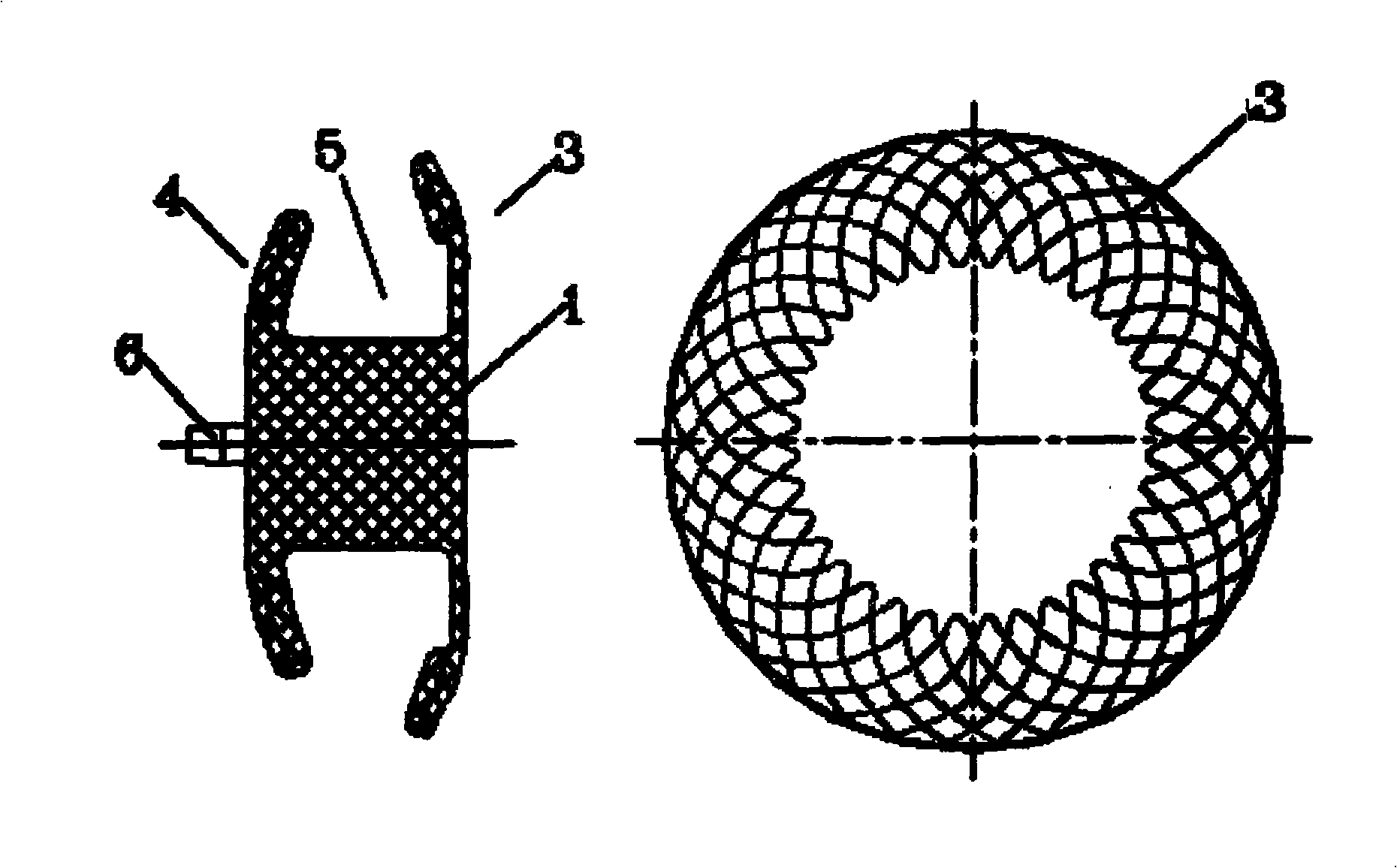 Blockage capable of reducing the thrombus source