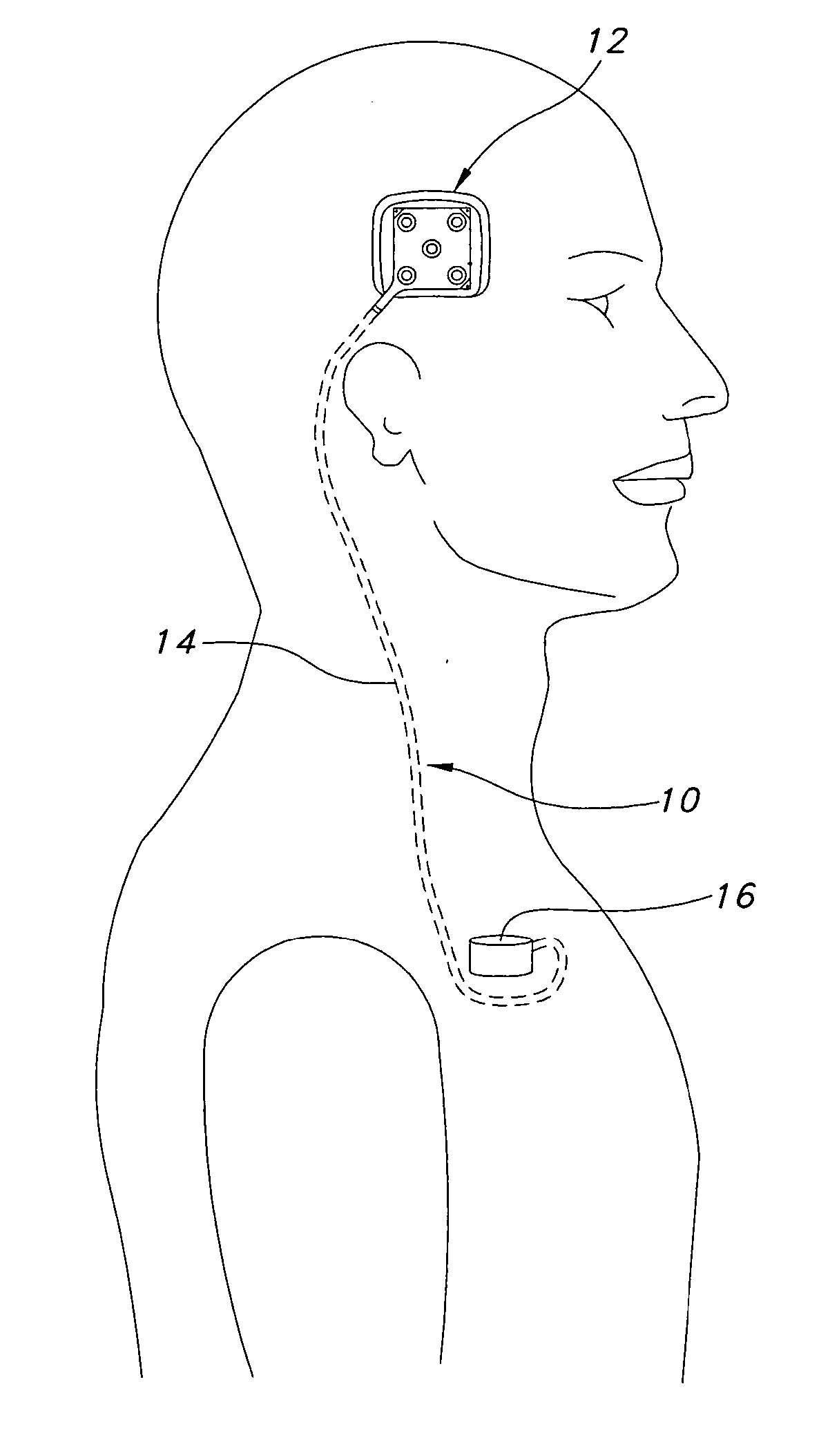 Apparatus and method for providing an electrical field to a targeted area