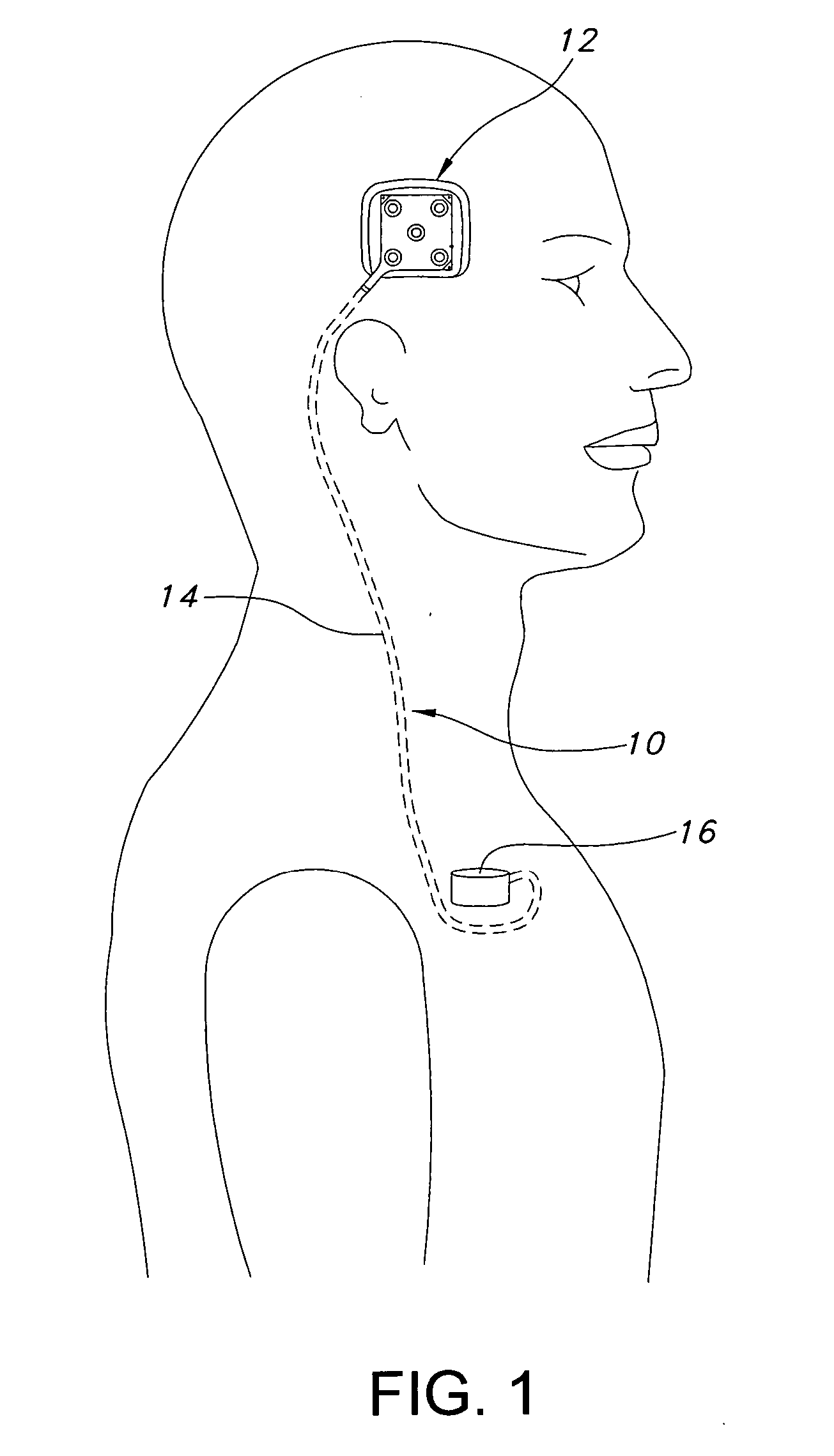 Apparatus and method for providing an electrical field to a targeted area