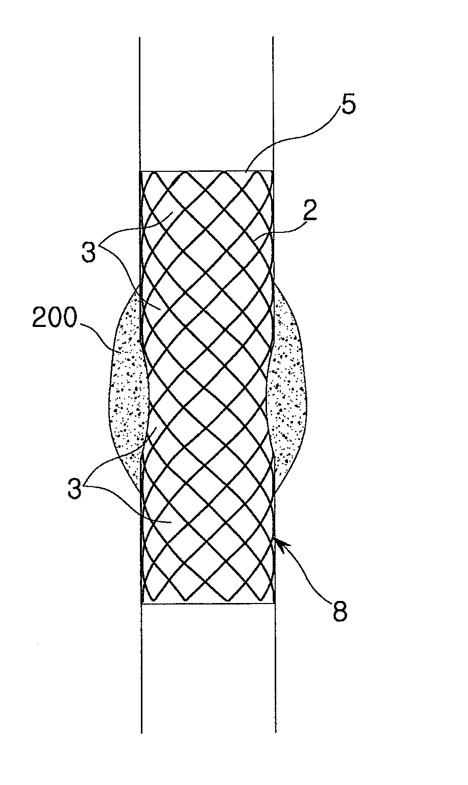Wavily deformable stent and method for producing the same