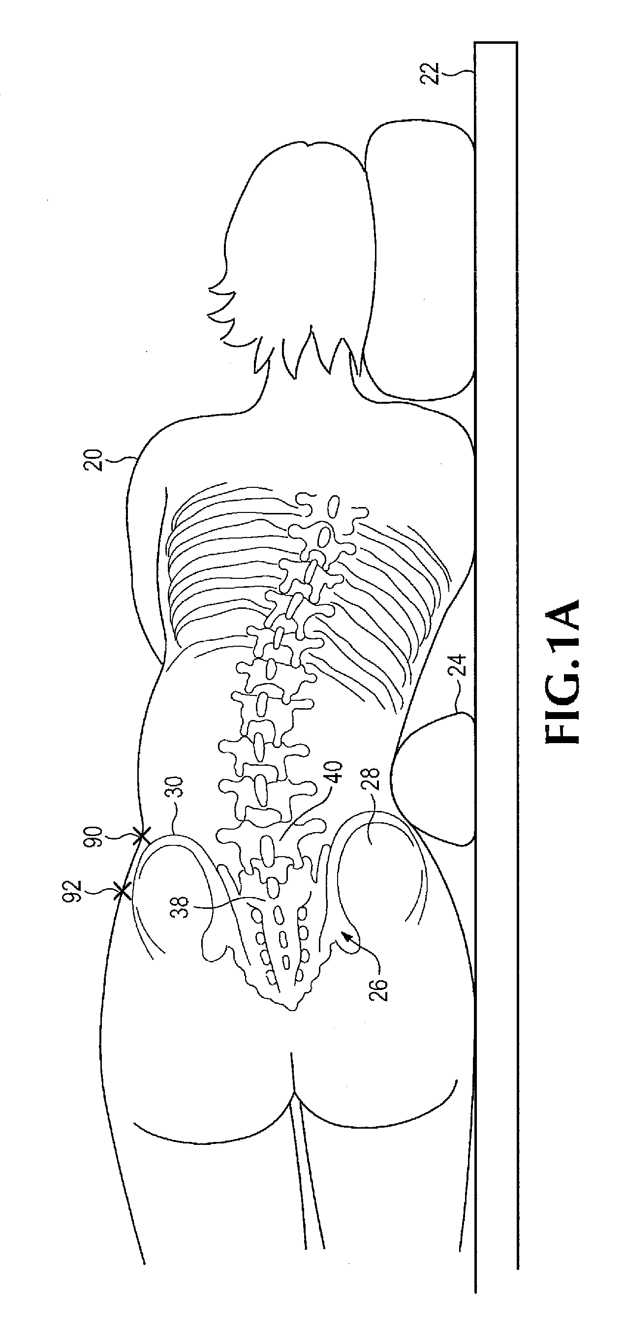 Spinal implant for use during retroperitoneal lateral insertion procedures