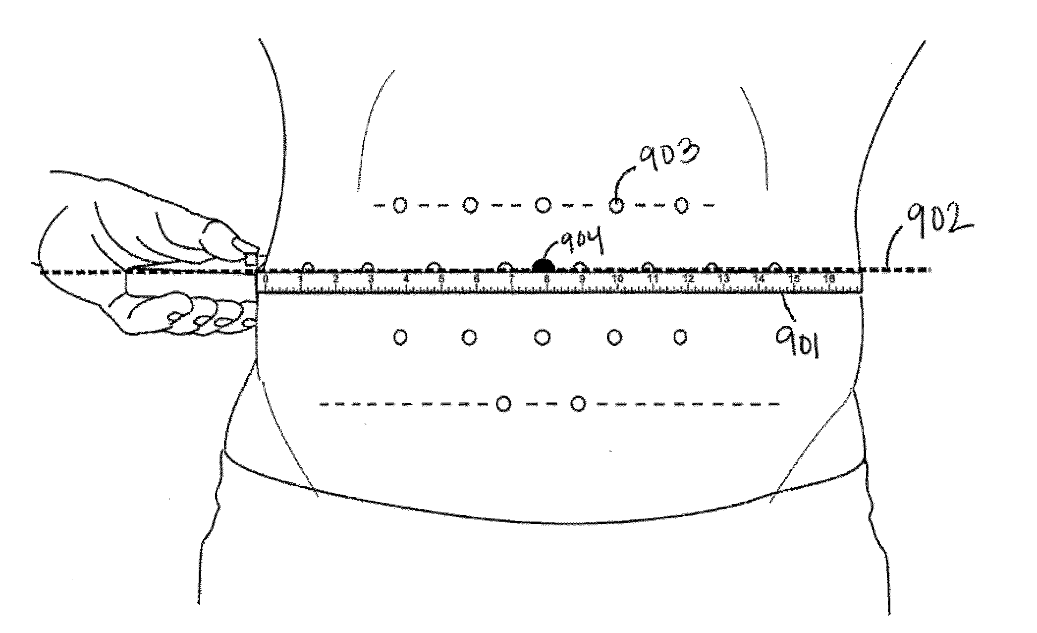 Method of treatment for body contouring
