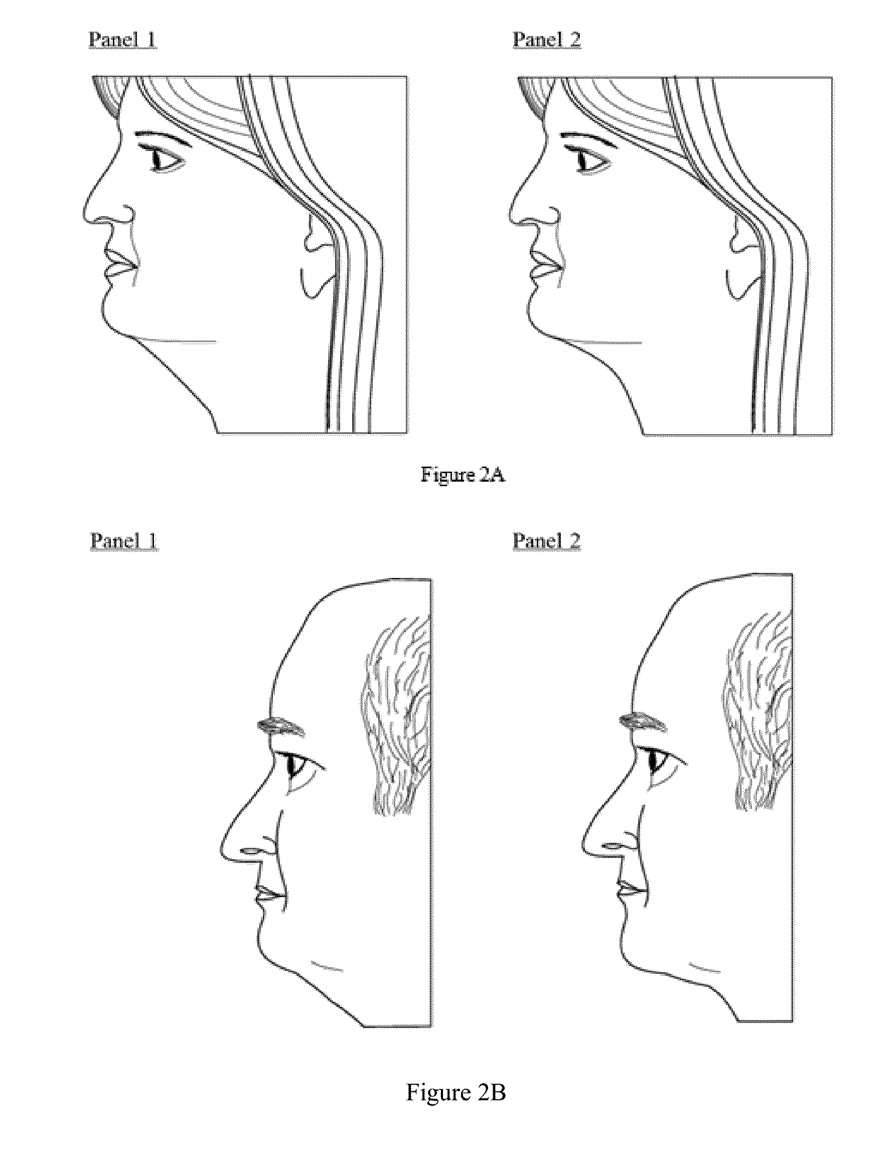 Method of treatment for body contouring