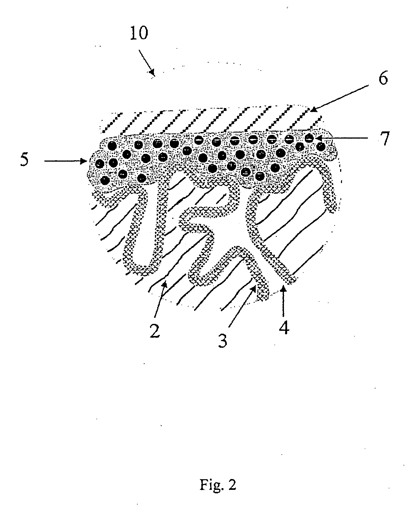 Electrolytic capacitors with a polymeric outer layer and process for the production thereof