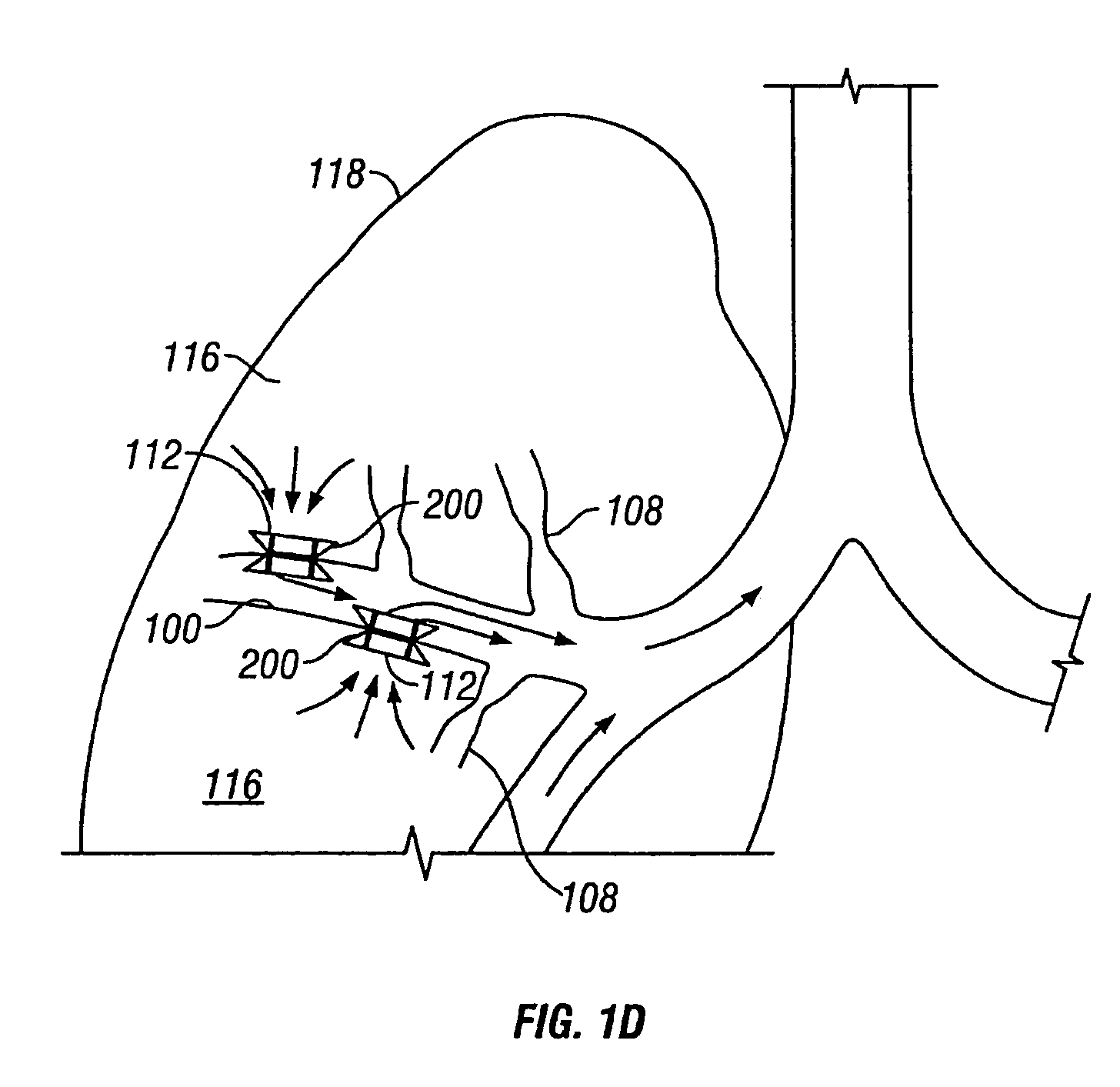 Devices for maintaining surgically created openings