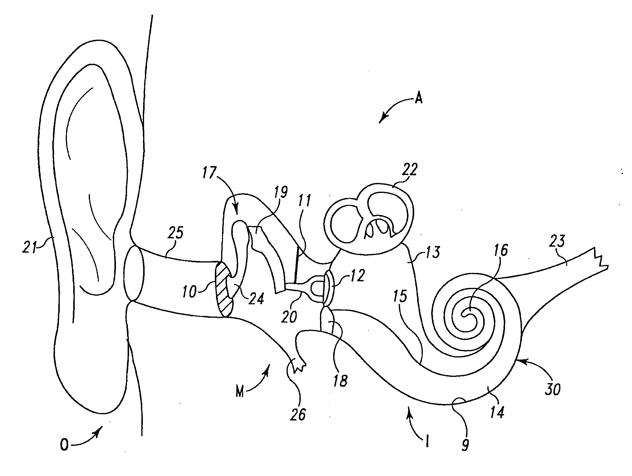 Extra-cochlear implanted hearing aid device