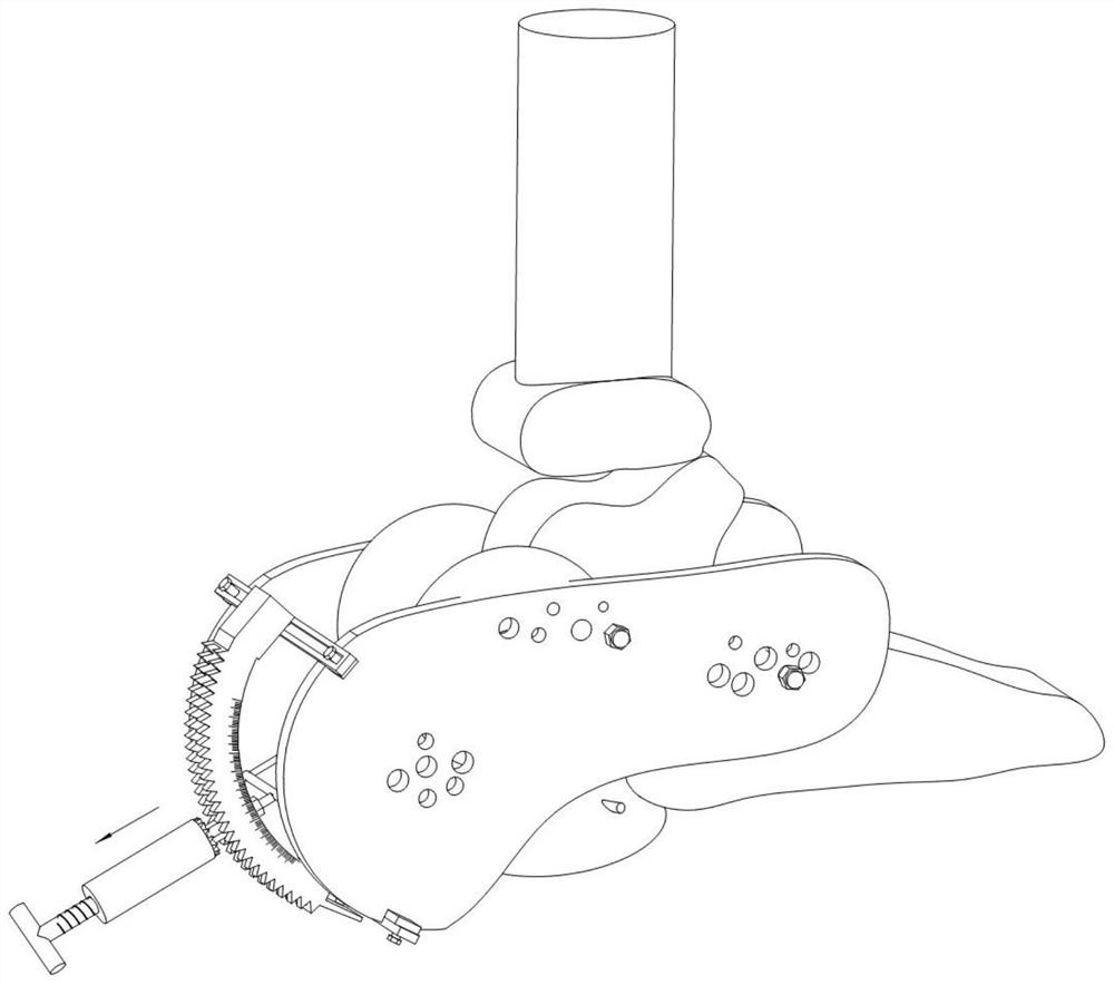 Closed reduction device for comminuted calcaneal fracture