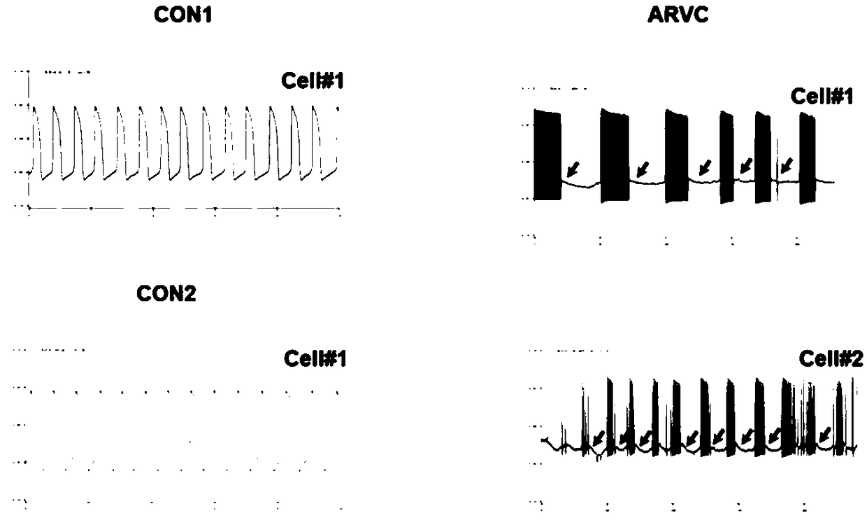 Method for establishing human arrhythmogenic right ventricular cardiomyopathy (ARVC) disease model